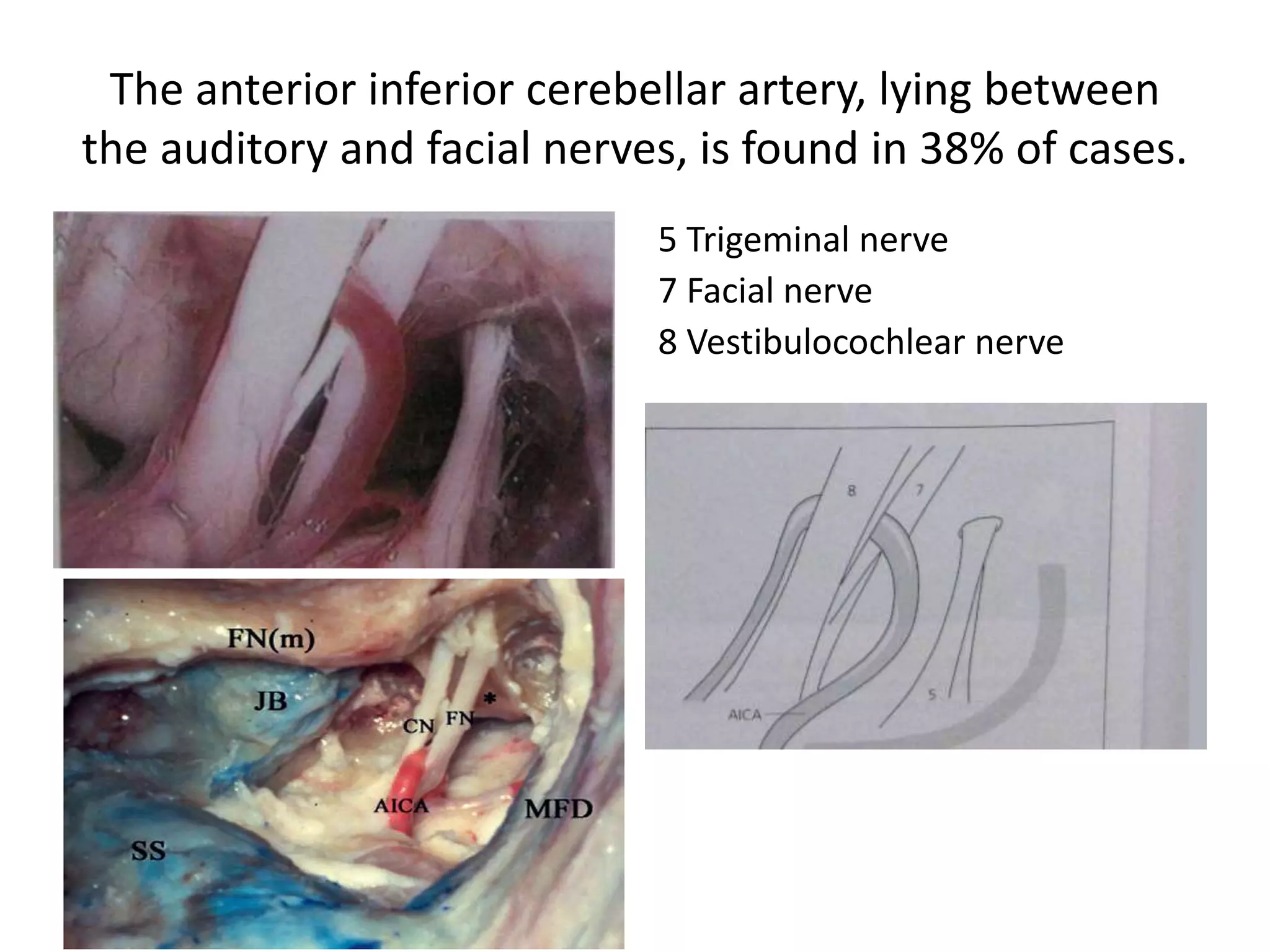 The anterior inferior cerebellar artery, lying between
the auditory and facial nerves, is found in 38% of cases.
5 Trigeminal nerve
7 Facial nerve
8 Vestibulocochlear nerve
 