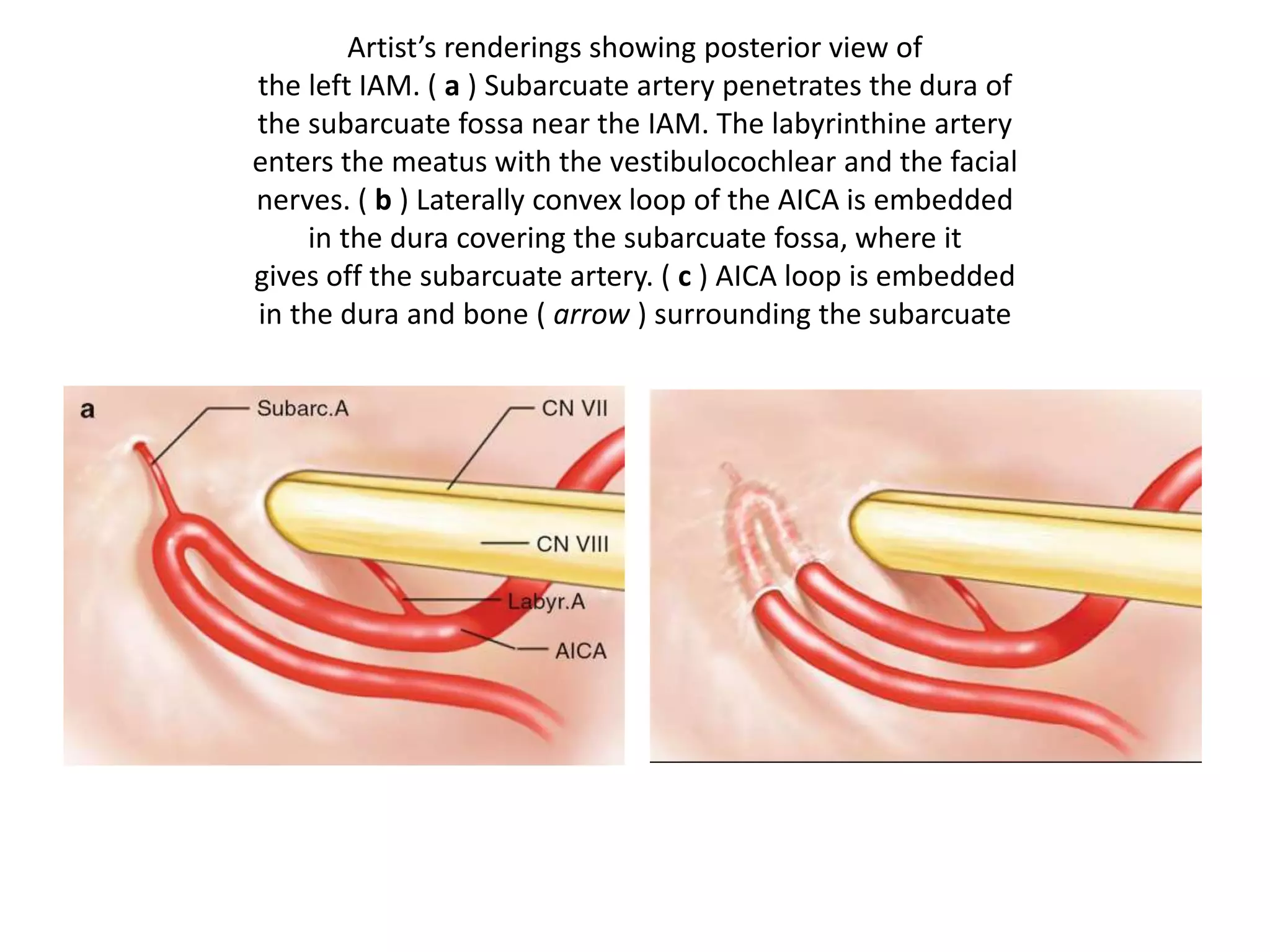 Artist’s renderings showing posterior view of
the left IAM. ( a ) Subarcuate artery penetrates the dura of
the subarcuate fossa near the IAM. The labyrinthine artery
enters the meatus with the vestibulocochlear and the facial
nerves. ( b ) Laterally convex loop of the AICA is embedded
in the dura covering the subarcuate fossa, where it
gives off the subarcuate artery. ( c ) AICA loop is embedded
in the dura and bone ( arrow ) surrounding the subarcuate
 