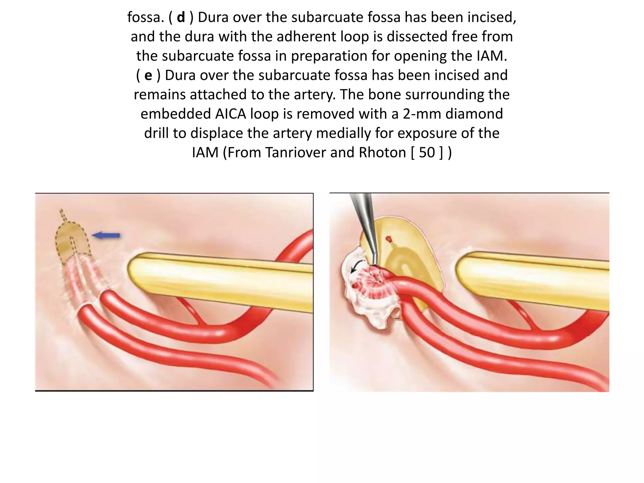 fossa. ( d ) Dura over the subarcuate fossa has been incised,
and the dura with the adherent loop is dissected free from
the subarcuate fossa in preparation for opening the IAM.
( e ) Dura over the subarcuate fossa has been incised and
remains attached to the artery. The bone surrounding the
embedded AICA loop is removed with a 2-mm diamond
drill to displace the artery medially for exposure of the
IAM (From Tanriover and Rhoton [ 50 ] )
 