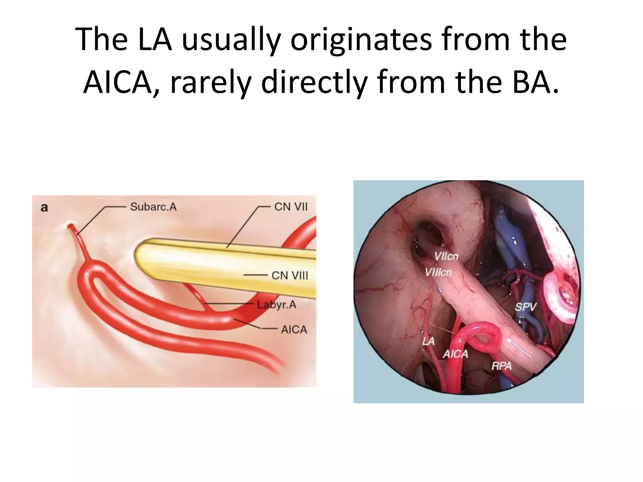 The LA usually originates from the
AICA, rarely directly from the BA.
 