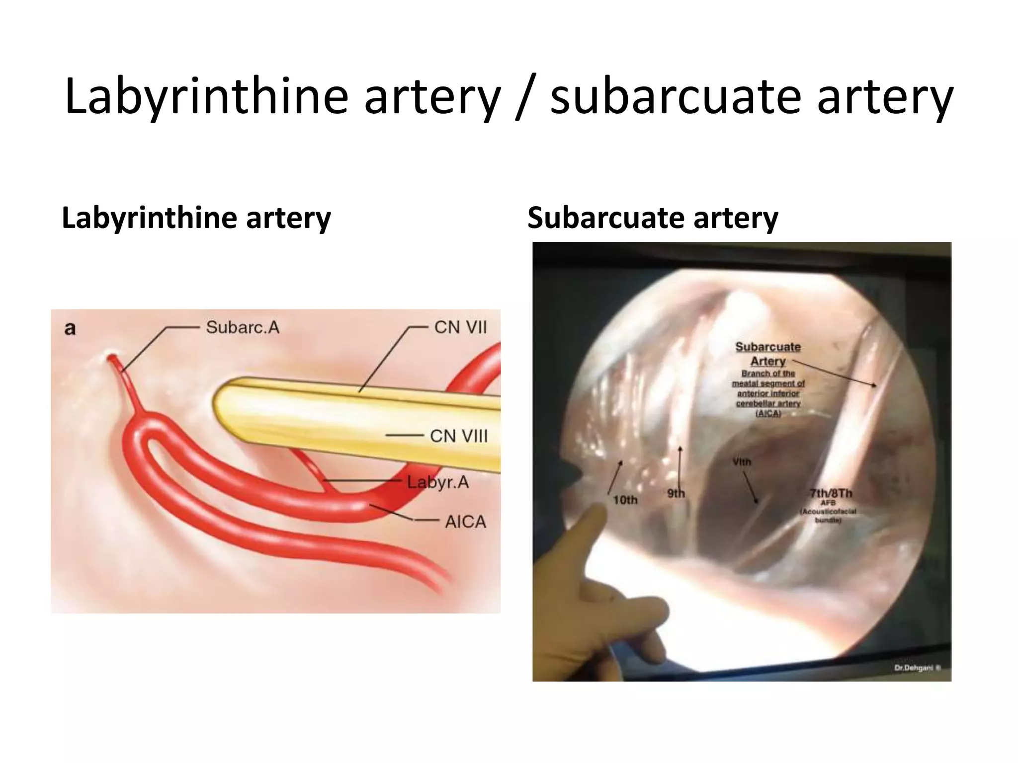 Labyrinthine artery / subarcuate artery
Labyrinthine artery Subarcuate artery
 
