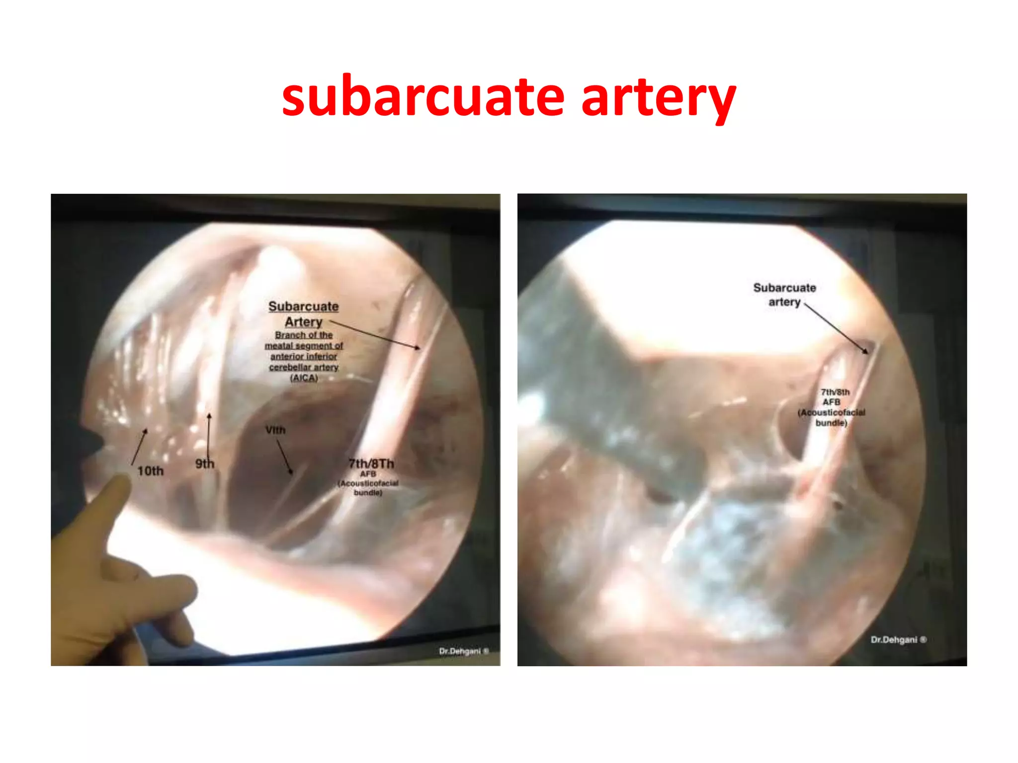 subarcuate artery
 