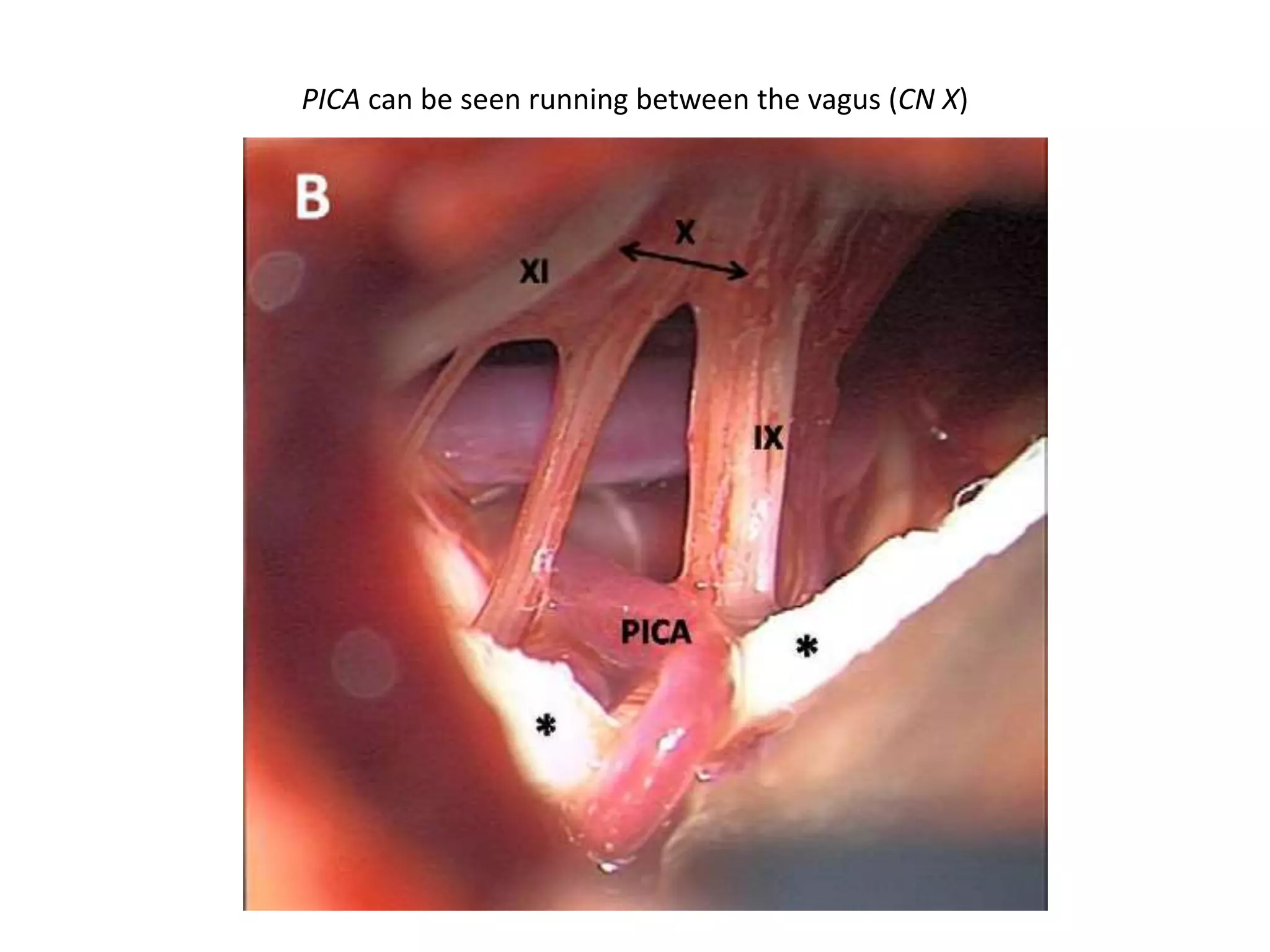 PICA can be seen running between the vagus (CN X)
 