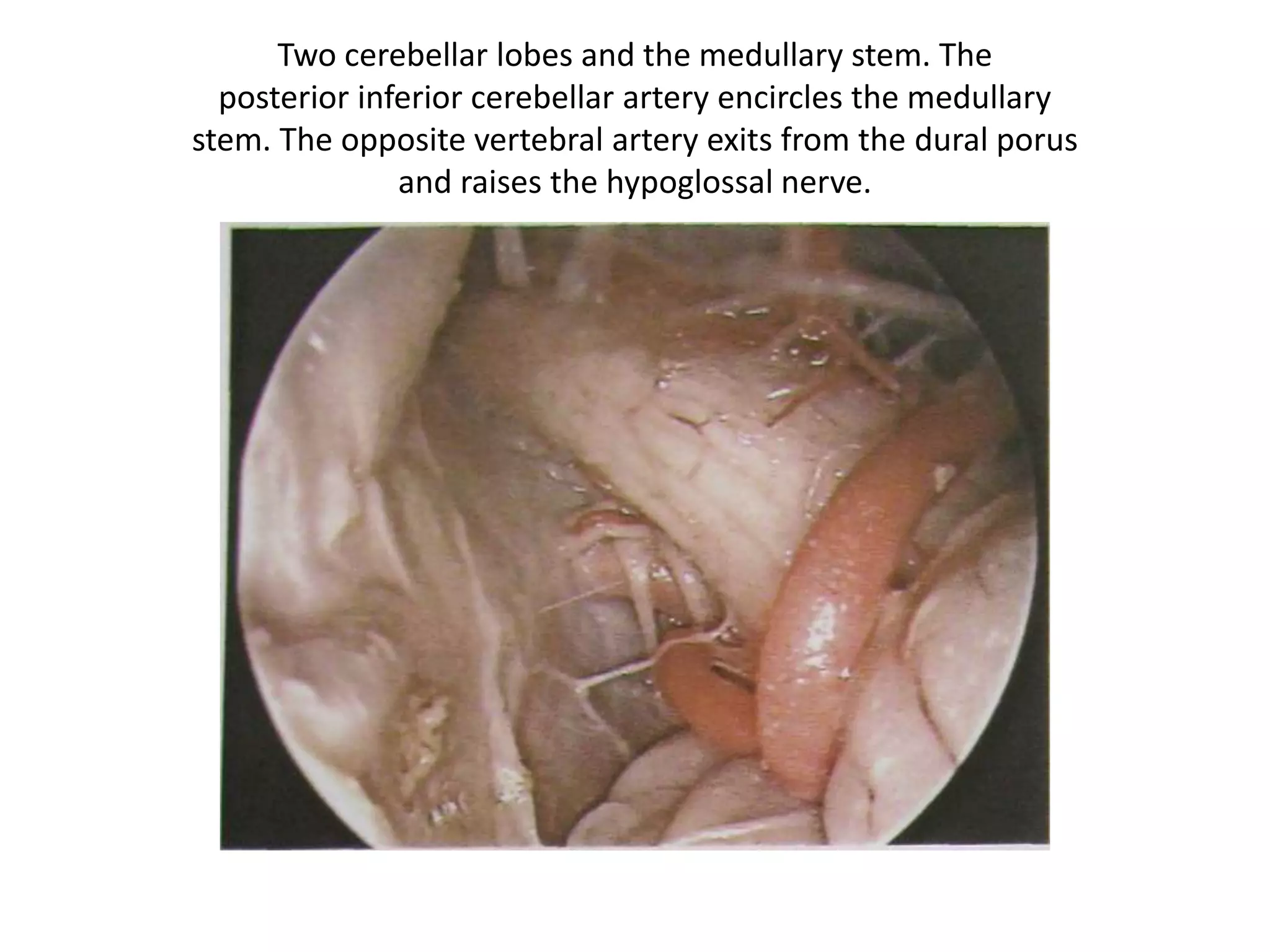 Two cerebellar lobes and the medullary stem. The
posterior inferior cerebellar artery encircles the medullary
stem. The opposite vertebral artery exits from the dural porus
and raises the hypoglossal nerve.
 