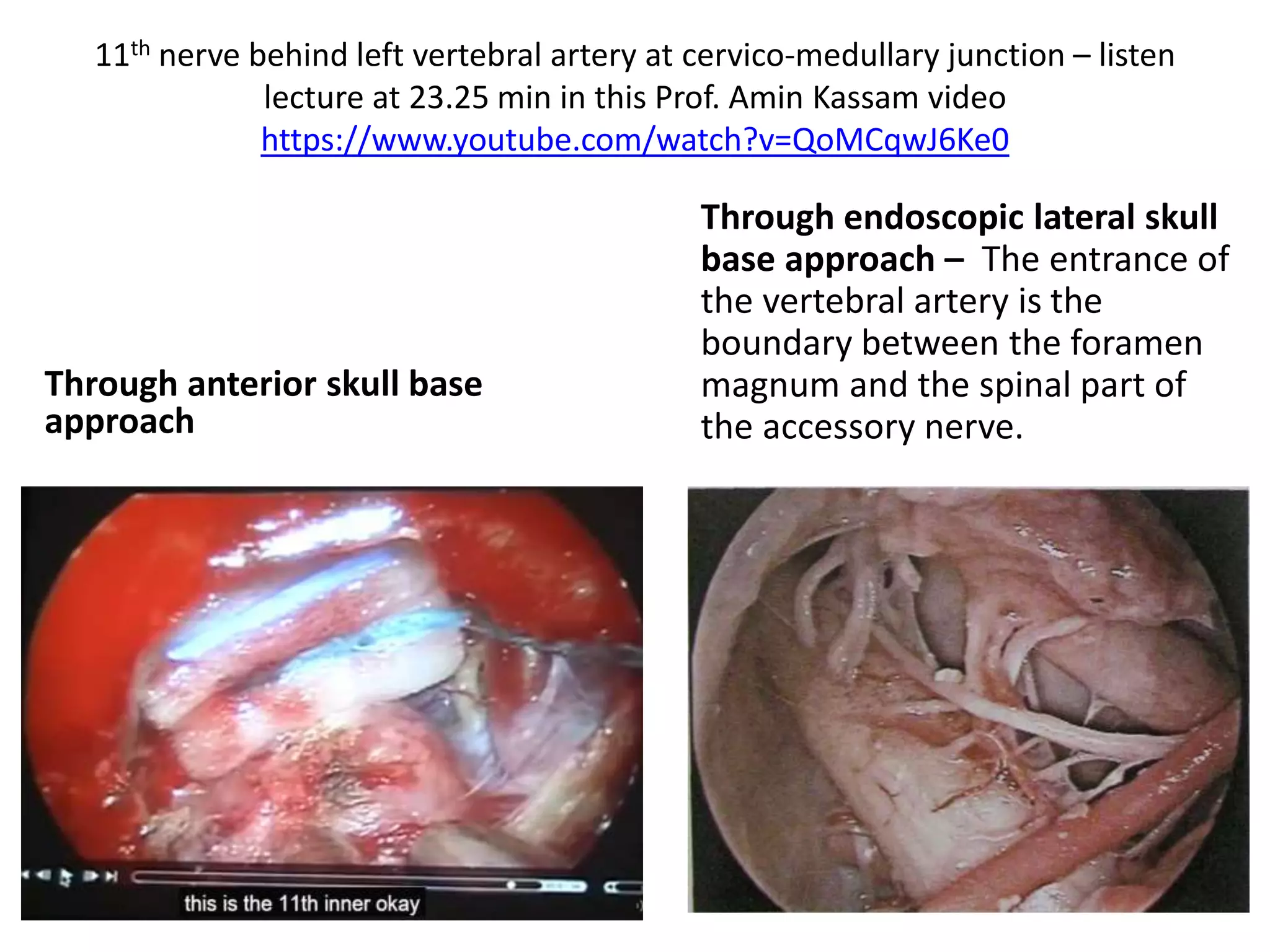 11th nerve behind left vertebral artery at cervico-medullary junction – listen
lecture at 23.25 min in this Prof. Amin Kassam video
https://www.youtube.com/watch?v=QoMCqwJ6Ke0
Through anterior skull base
approach
Through endoscopic lateral skull
base approach – The entrance of
the vertebral artery is the
boundary between the foramen
magnum and the spinal part of
the accessory nerve.
 