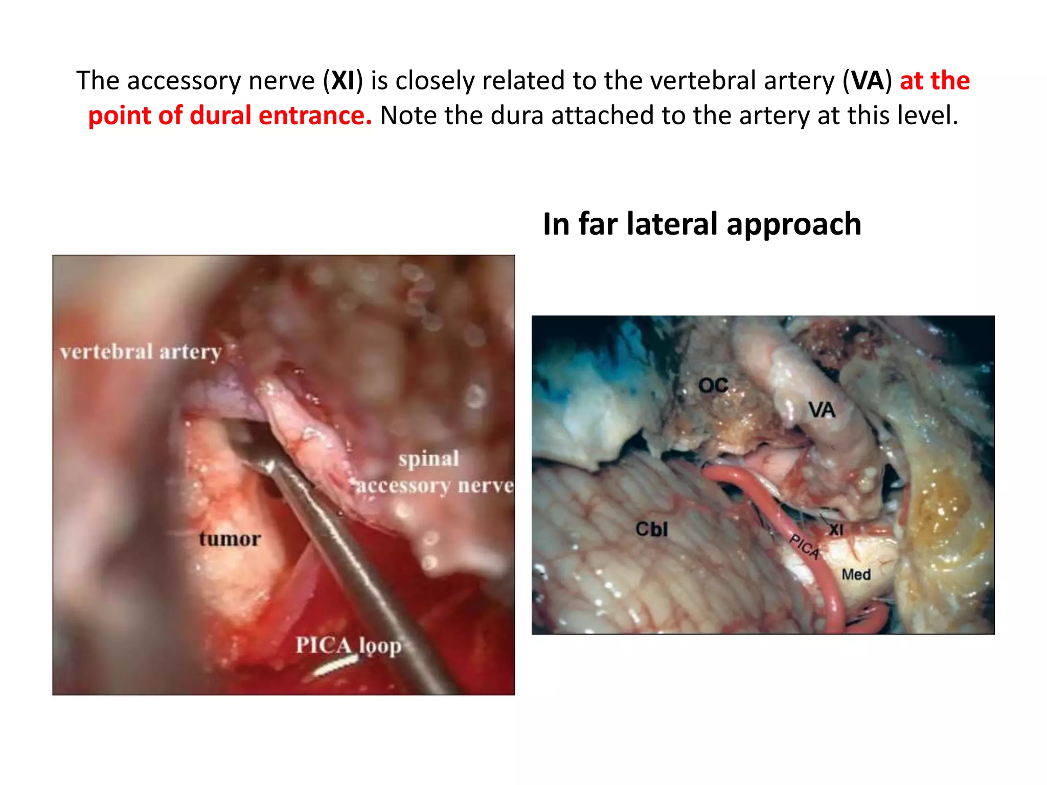 The accessory nerve (XI) is closely related to the vertebral artery (VA) at the
point of dural entrance. Note the dura attached to the artery at this level.
In far lateral approach
 