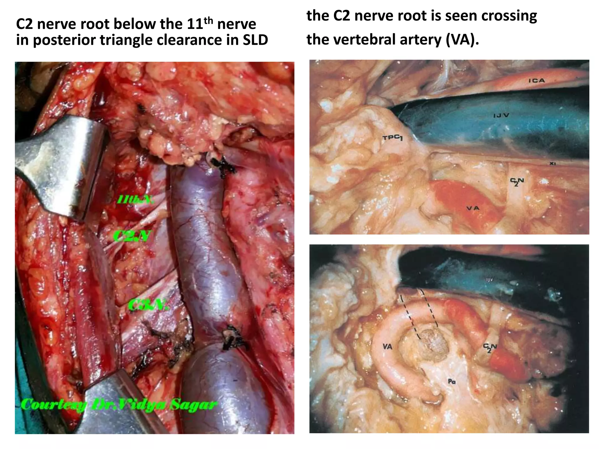C2 nerve root below the 11th nerve
in posterior triangle clearance in SLD
the C2 nerve root is seen crossing
the vertebral artery (VA).
 