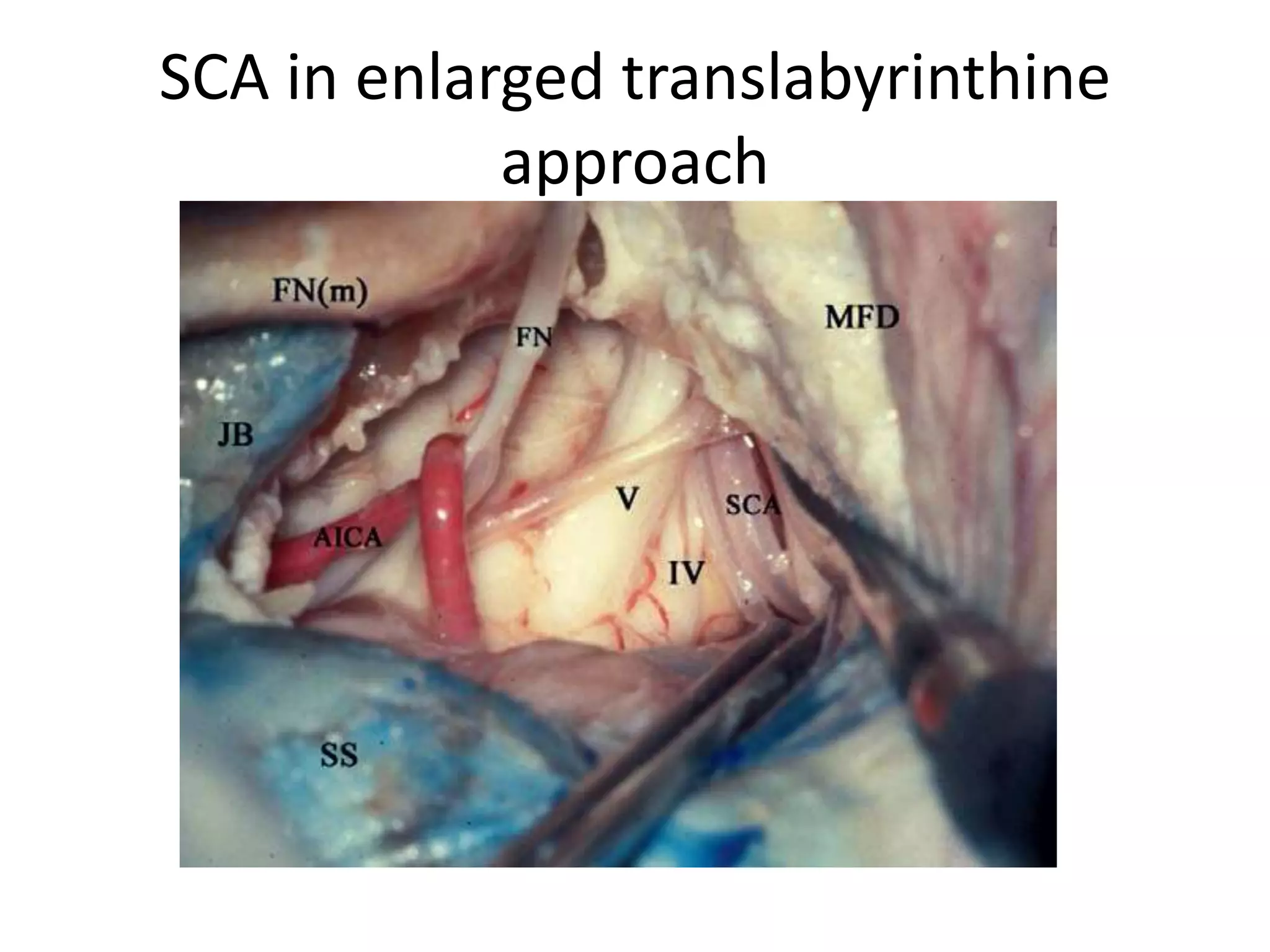 SCA in enlarged translabyrinthine
approach
 
