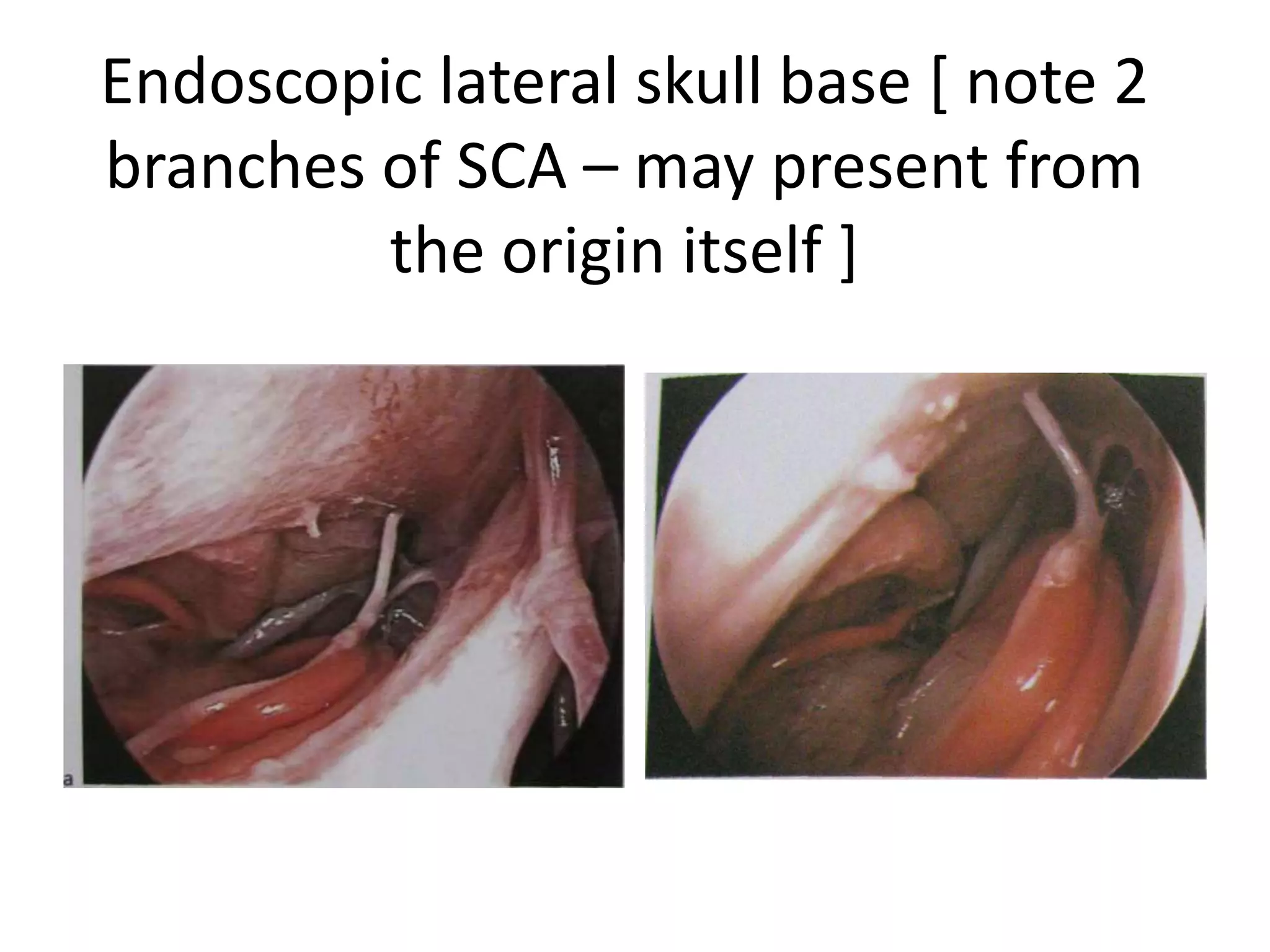 Endoscopic lateral skull base [ note 2
branches of SCA – may present from
the origin itself ]
 