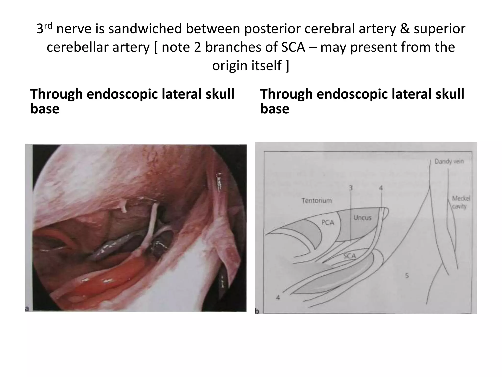 3rd nerve is sandwiched between posterior cerebral artery & superior
cerebellar artery [ note 2 branches of SCA – may present from the
origin itself ]
Through endoscopic lateral skull
base
Through endoscopic lateral skull
base
 