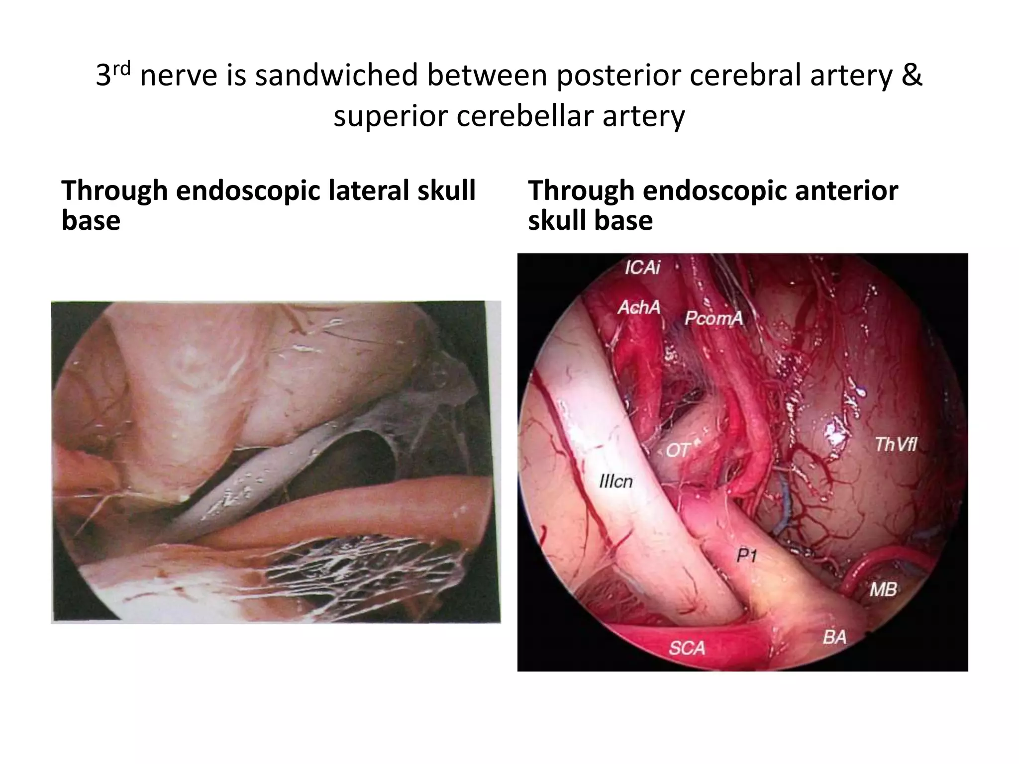 3rd nerve is sandwiched between posterior cerebral artery &
superior cerebellar artery
Through endoscopic lateral skull
base
Through endoscopic anterior
skull base
 