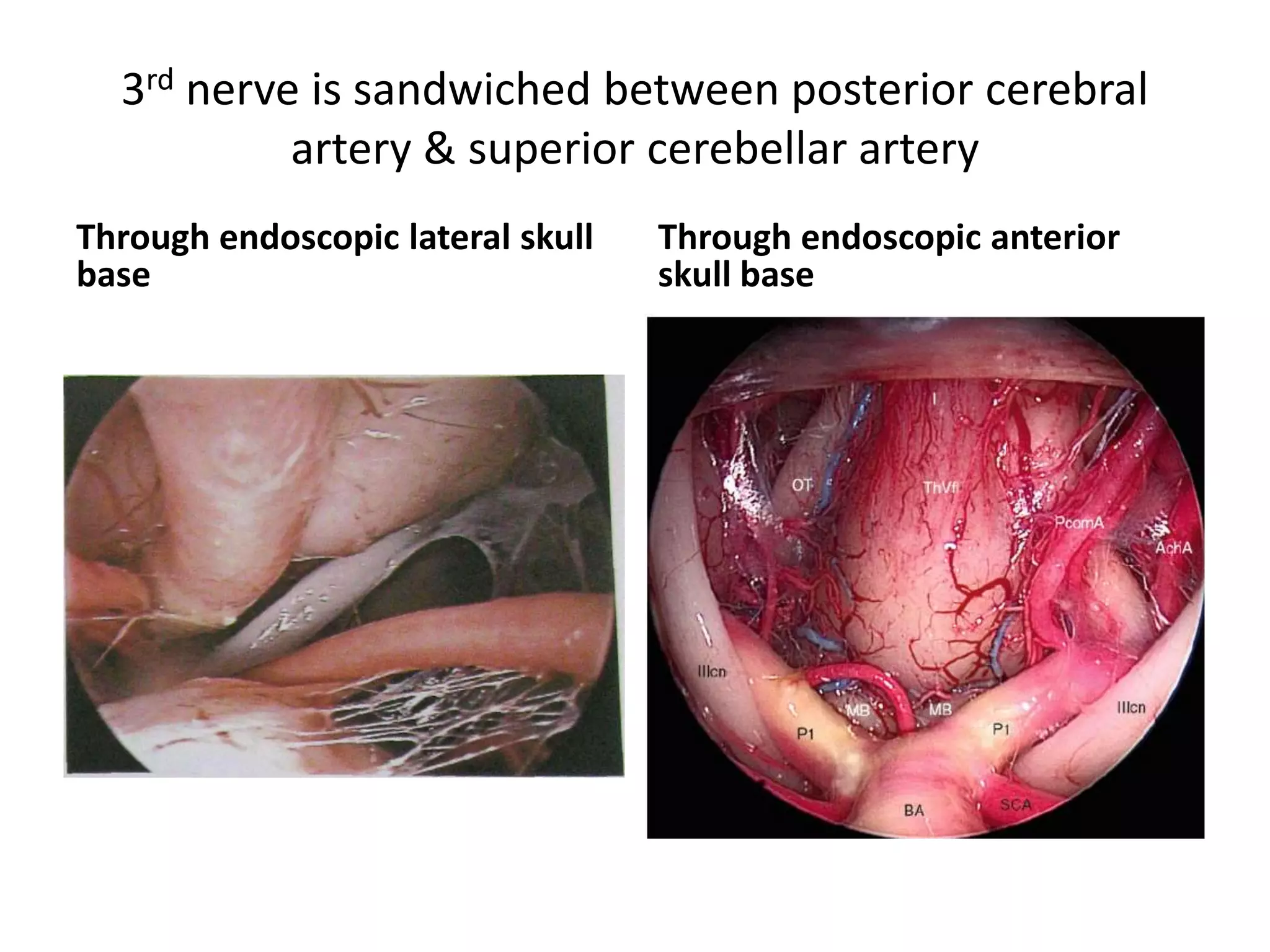 3rd nerve is sandwiched between posterior cerebral
artery & superior cerebellar artery
Through endoscopic lateral skull
base
Through endoscopic anterior
skull base
 