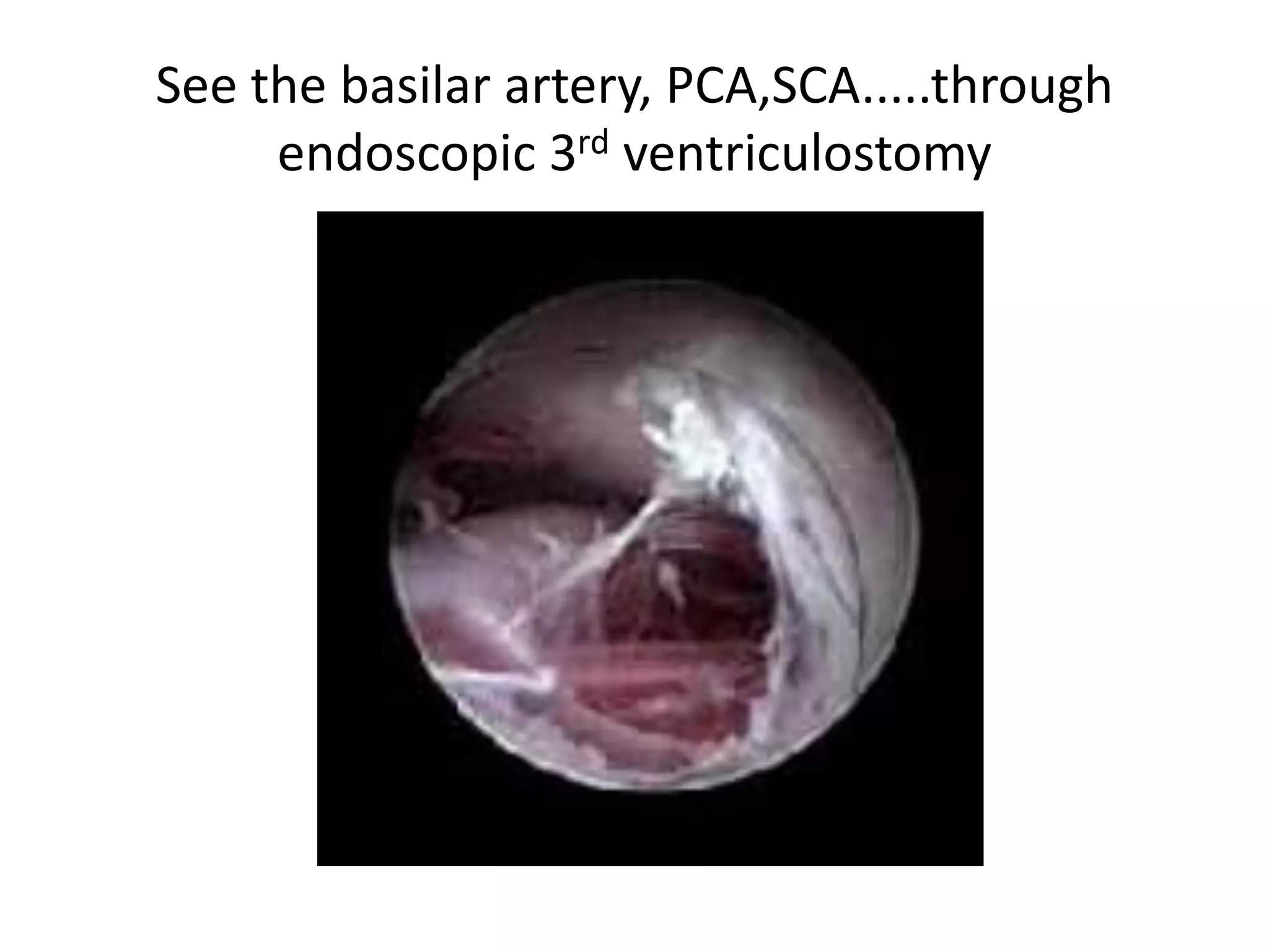 See the basilar artery, PCA,SCA.....through
endoscopic 3rd ventriculostomy
 