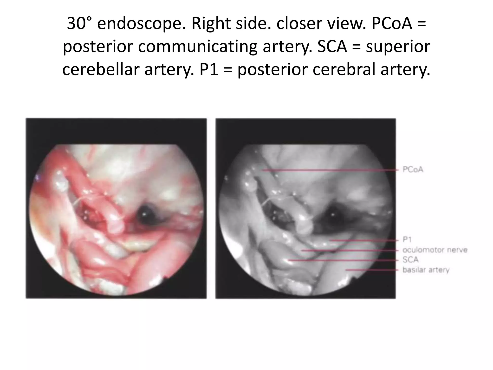 30° endoscope. Right side. closer view. PCoA =
posterior communicating artery. SCA = superior
cerebellar artery. P1 = posterior cerebral artery.
 