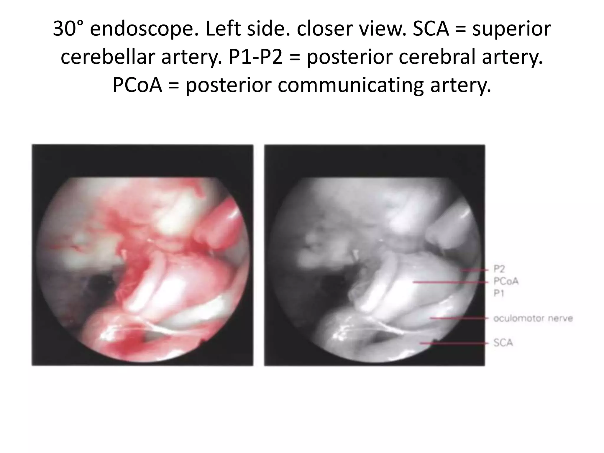30° endoscope. Left side. closer view. SCA = superior
cerebellar artery. P1-P2 = posterior cerebral artery.
PCoA = posterior communicating artery.
 
