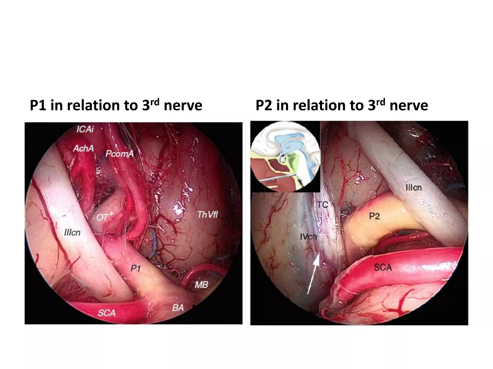 P1 in relation to 3rd nerve P2 in relation to 3rd nerve
 