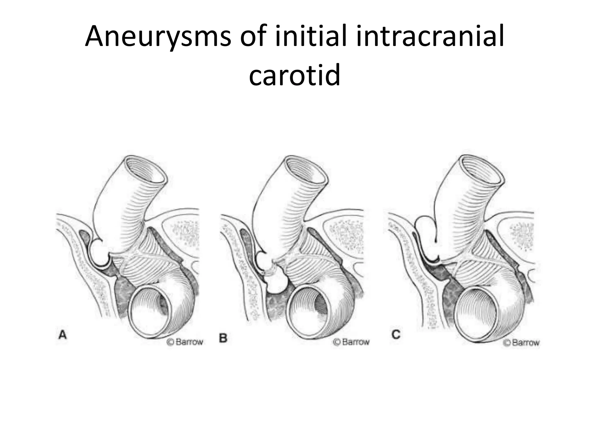 Aneurysms of initial intracranial
carotid
 