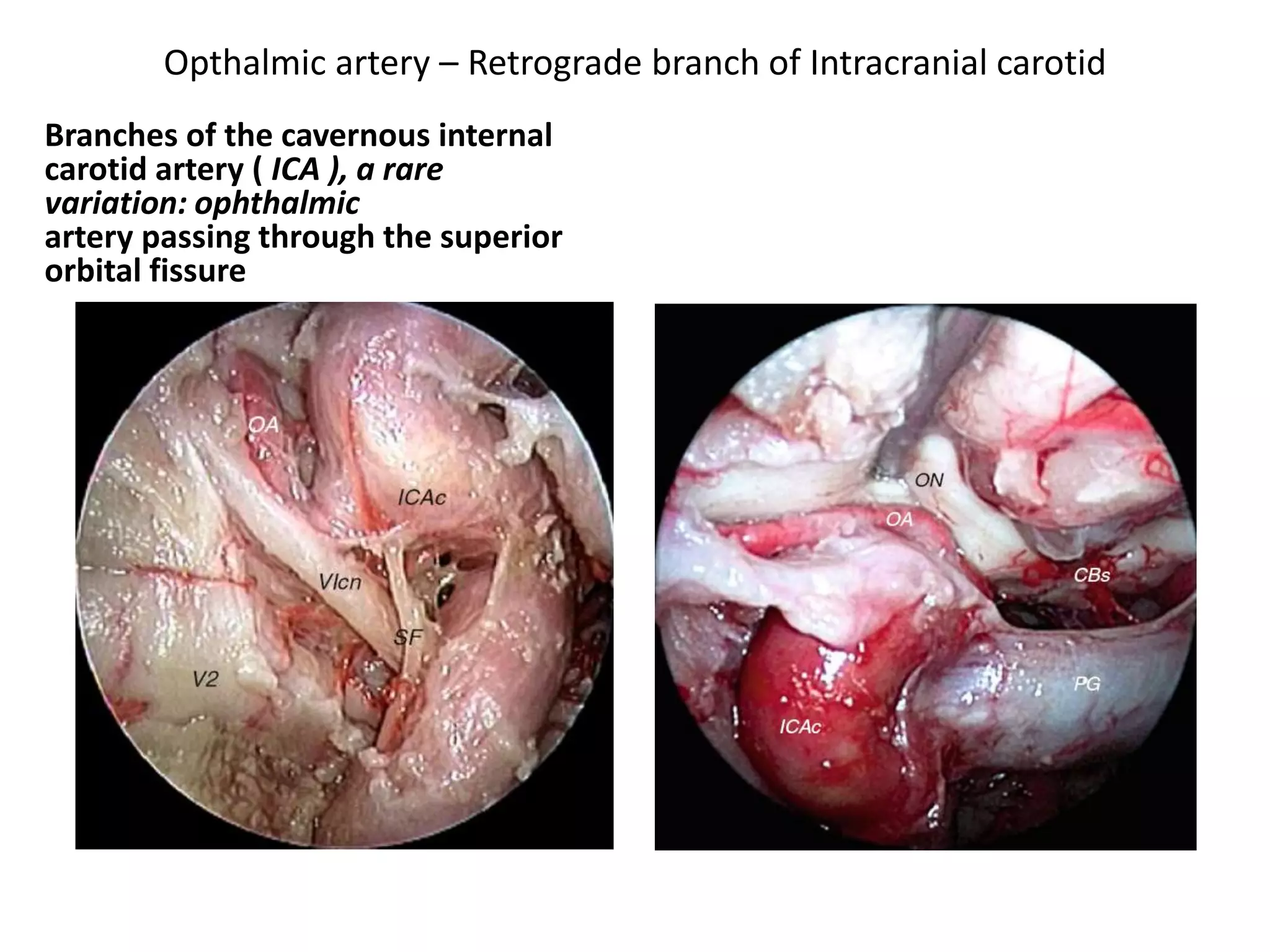 Opthalmic artery – Retrograde branch of Intracranial carotid
Branches of the cavernous internal
carotid artery ( ICA ), a rare
variation: ophthalmic
artery passing through the superior
orbital fissure
 
