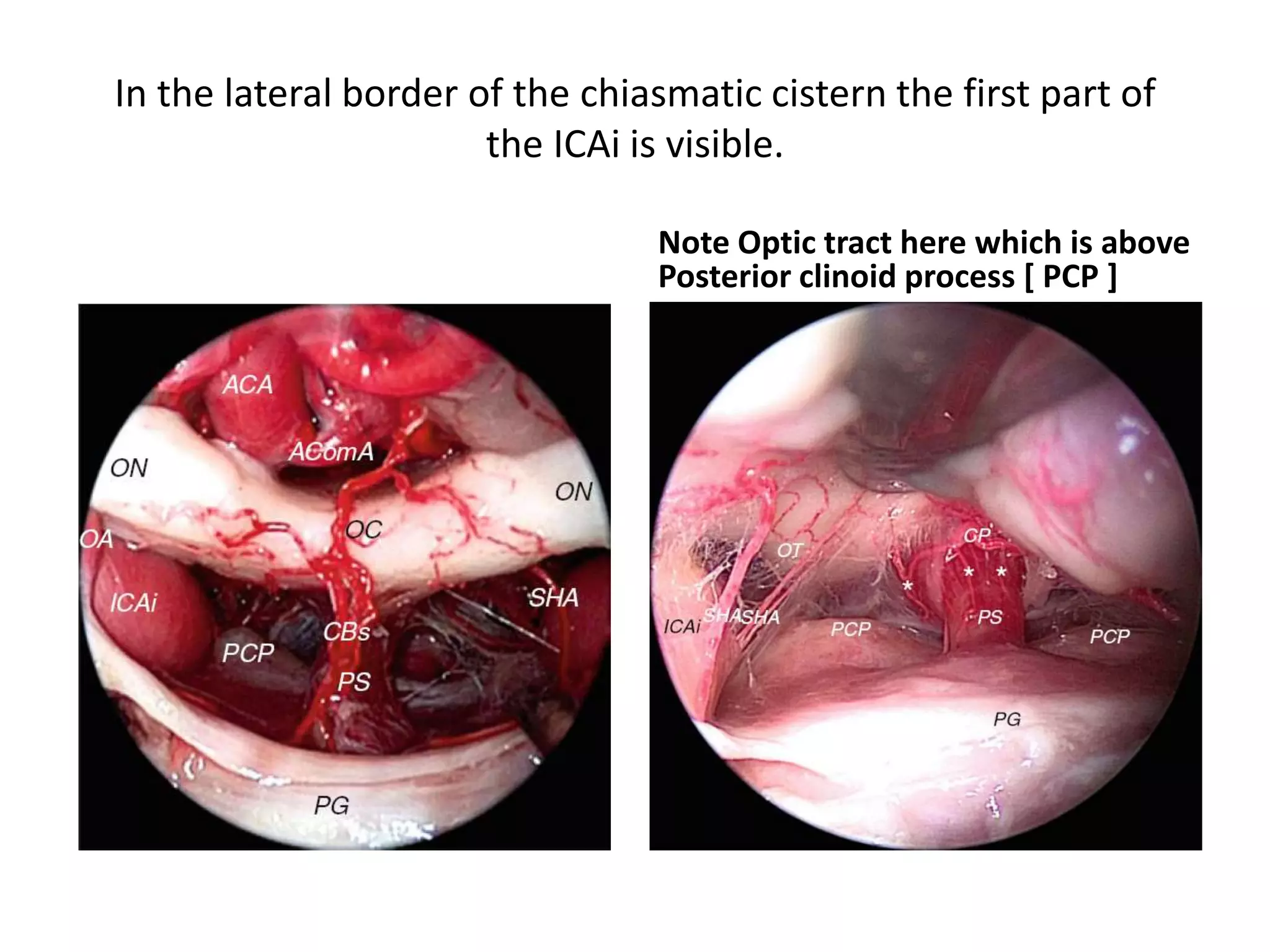 In the lateral border of the chiasmatic cistern the first part of
the ICAi is visible.
Note Optic tract here which is above
Posterior clinoid process [ PCP ]
 