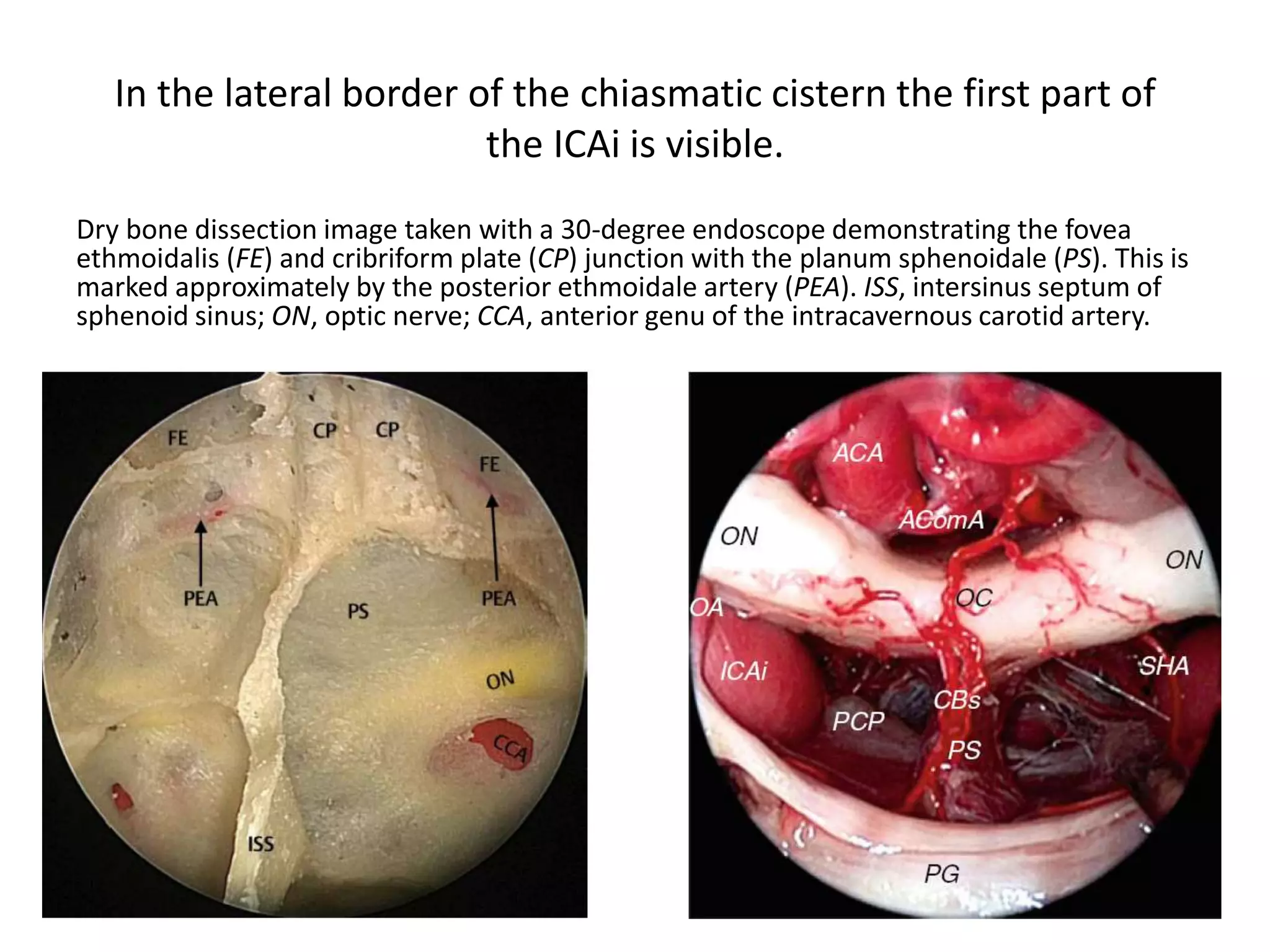 In the lateral border of the chiasmatic cistern the first part of
the ICAi is visible.
Dry bone dissection image taken with a 30-degree endoscope demonstrating the fovea
ethmoidalis (FE) and cribriform plate (CP) junction with the planum sphenoidale (PS). This is
marked approximately by the posterior ethmoidale artery (PEA). ISS, intersinus septum of
sphenoid sinus; ON, optic nerve; CCA, anterior genu of the intracavernous carotid artery.
 