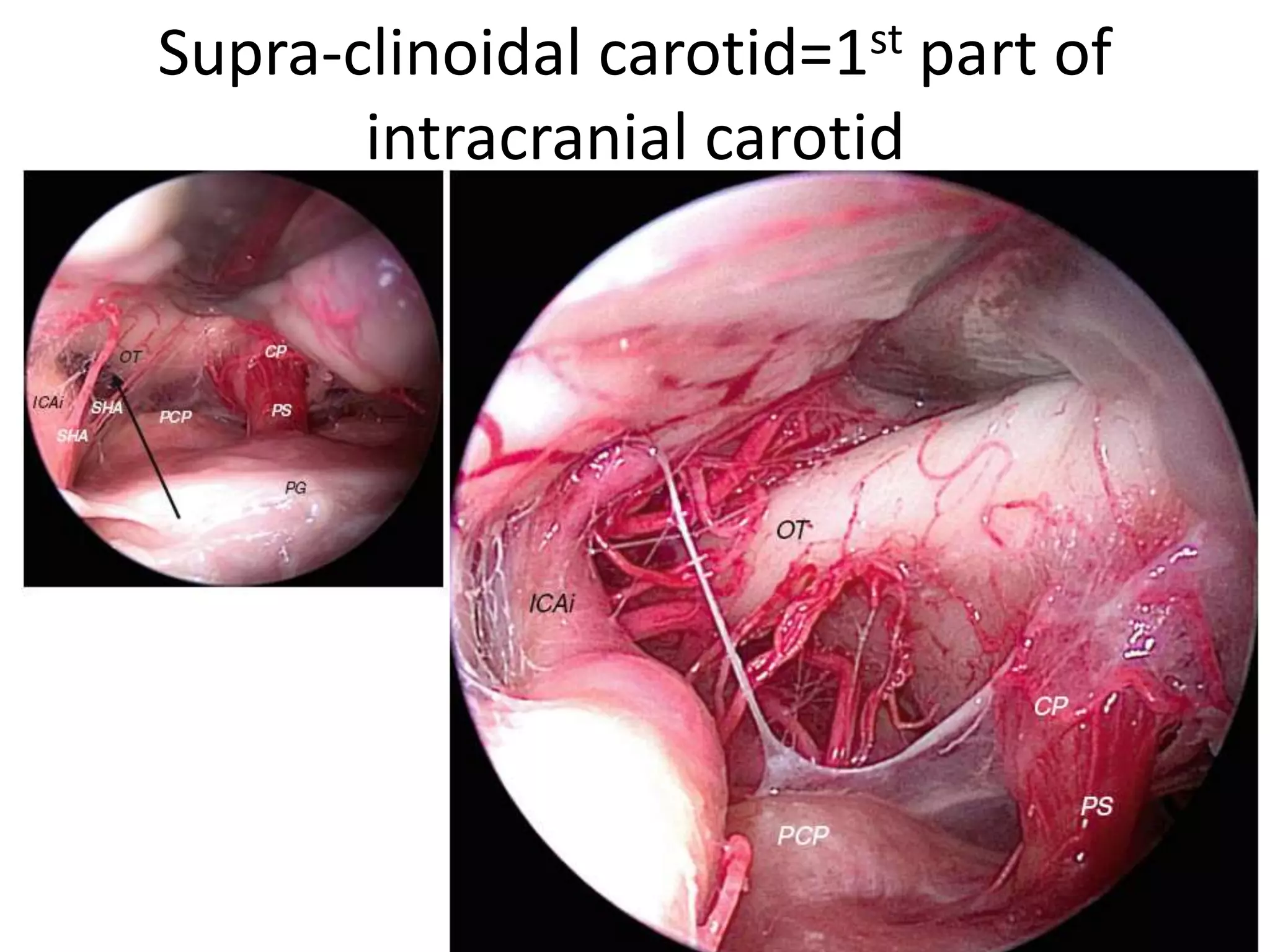 Supra-clinoidal carotid=1st part of
intracranial carotid
 