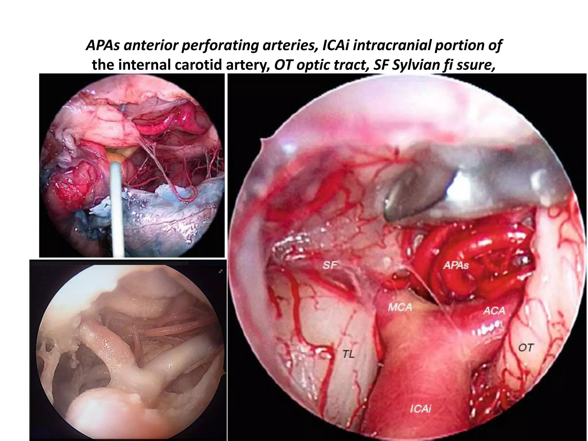 APAs anterior perforating arteries, ICAi intracranial portion of
the internal carotid artery, OT optic tract, SF Sylvian fi ssure,
 