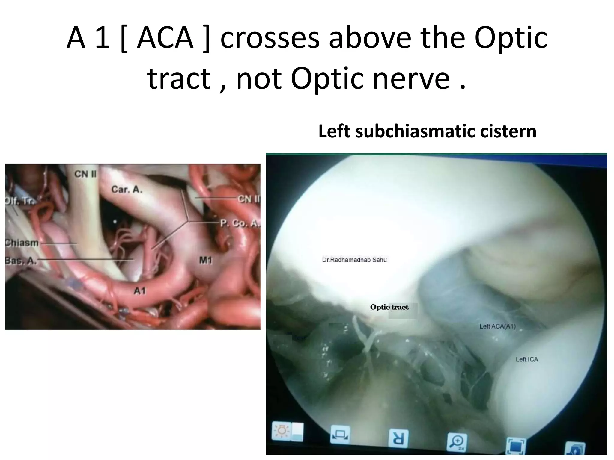 A 1 [ ACA ] crosses above the Optic
tract , not Optic nerve .
Left subchiasmatic cistern
 