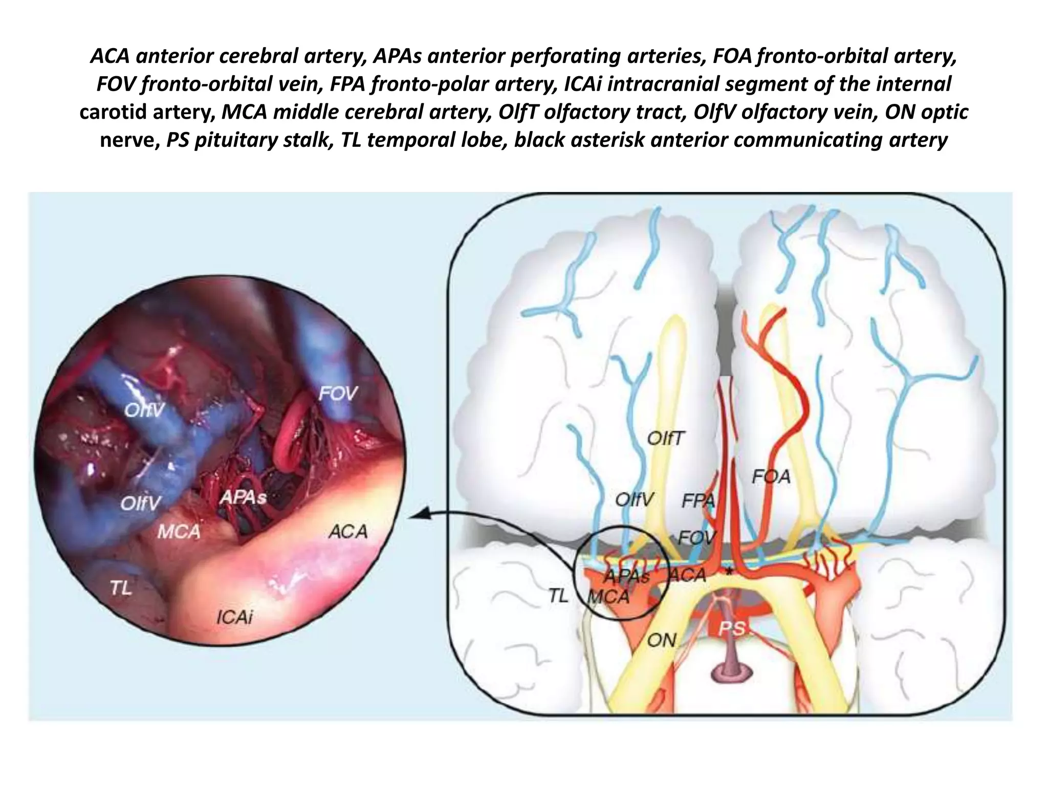 ACA anterior cerebral artery, APAs anterior perforating arteries, FOA fronto-orbital artery,
FOV fronto-orbital vein, FPA fronto-polar artery, ICAi intracranial segment of the internal
carotid artery, MCA middle cerebral artery, OlfT olfactory tract, OlfV olfactory vein, ON optic
nerve, PS pituitary stalk, TL temporal lobe, black asterisk anterior communicating artery
 