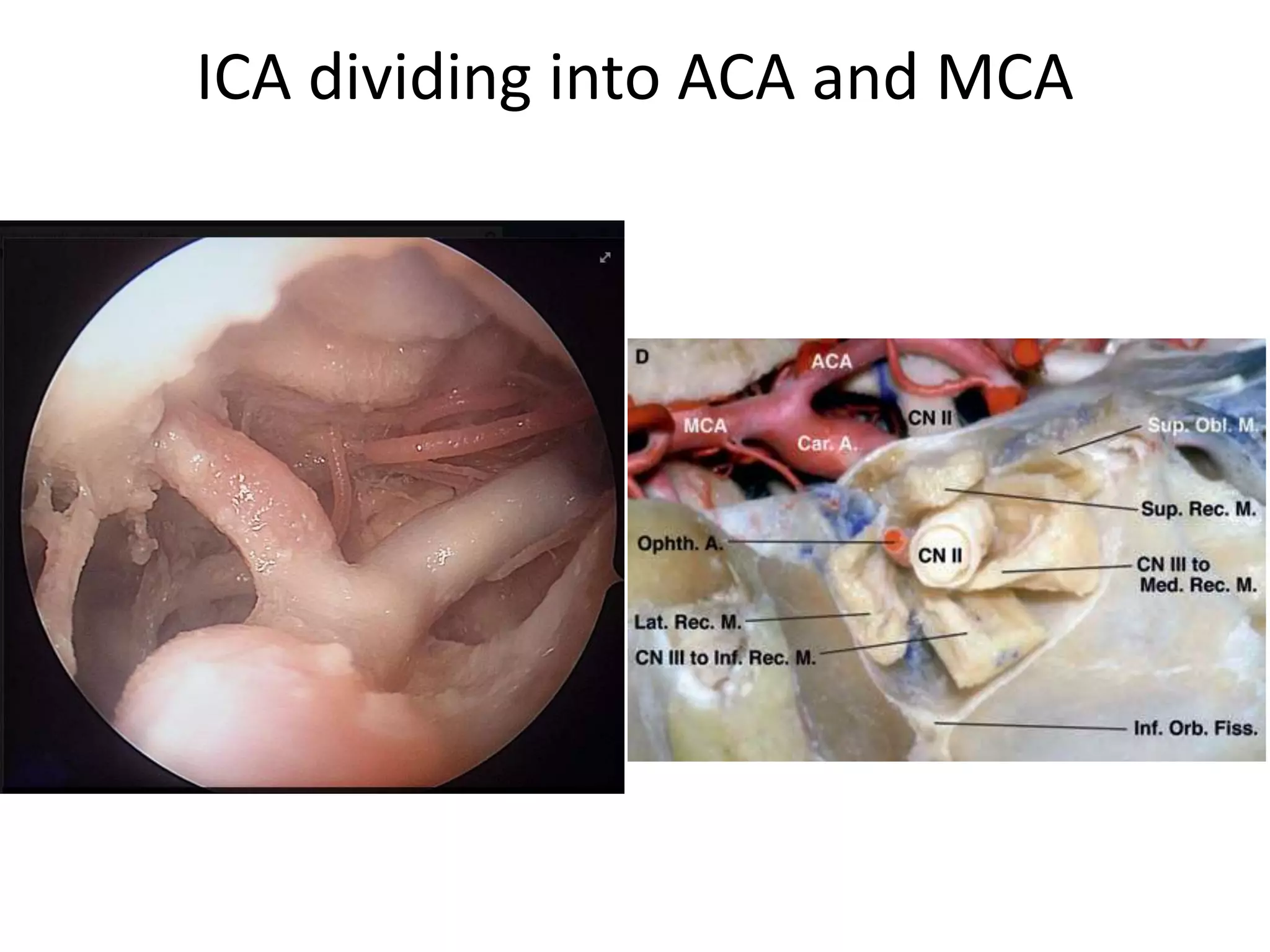 ICA dividing into ACA and MCA
 