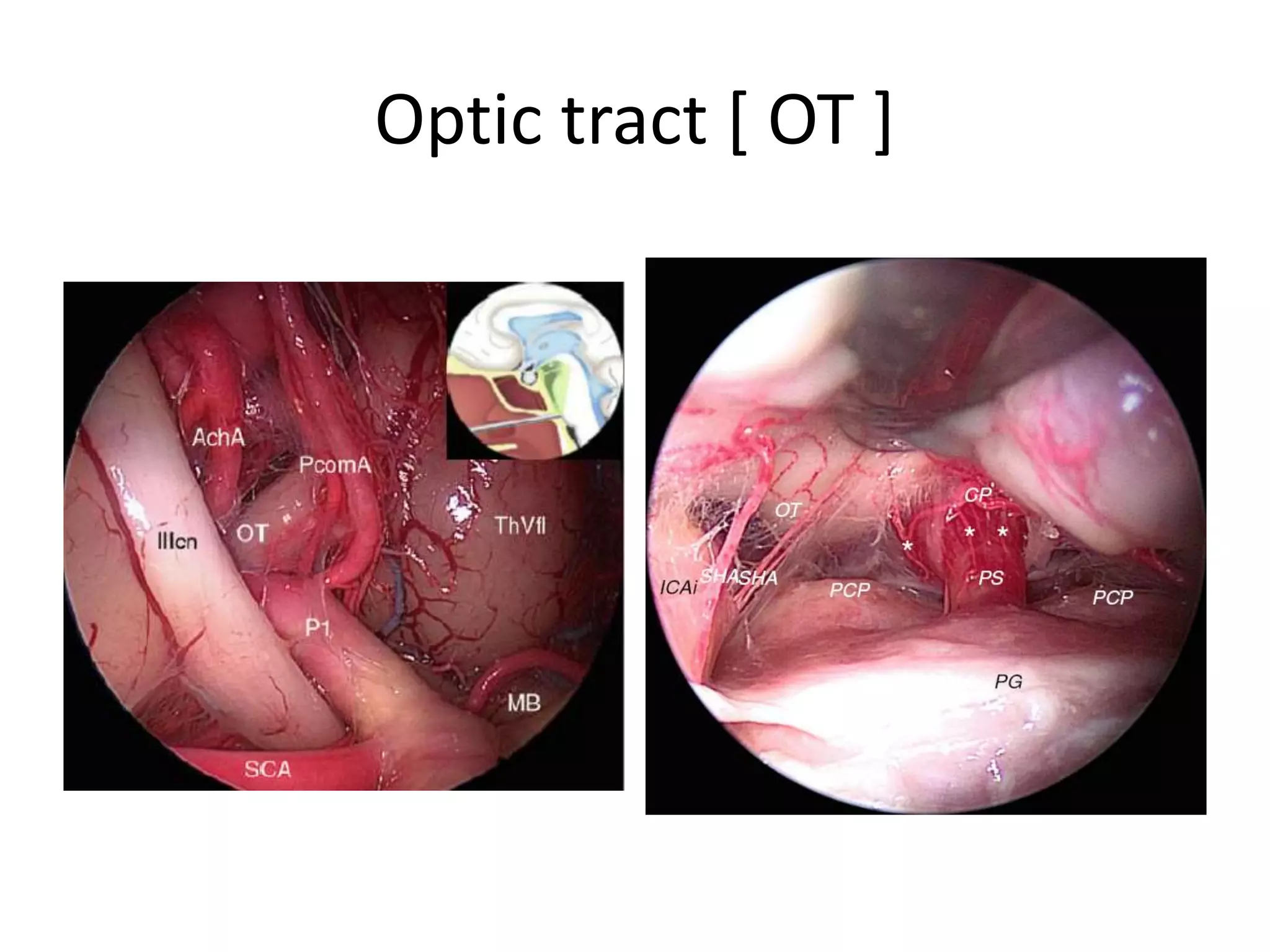Optic tract [ OT ]
 