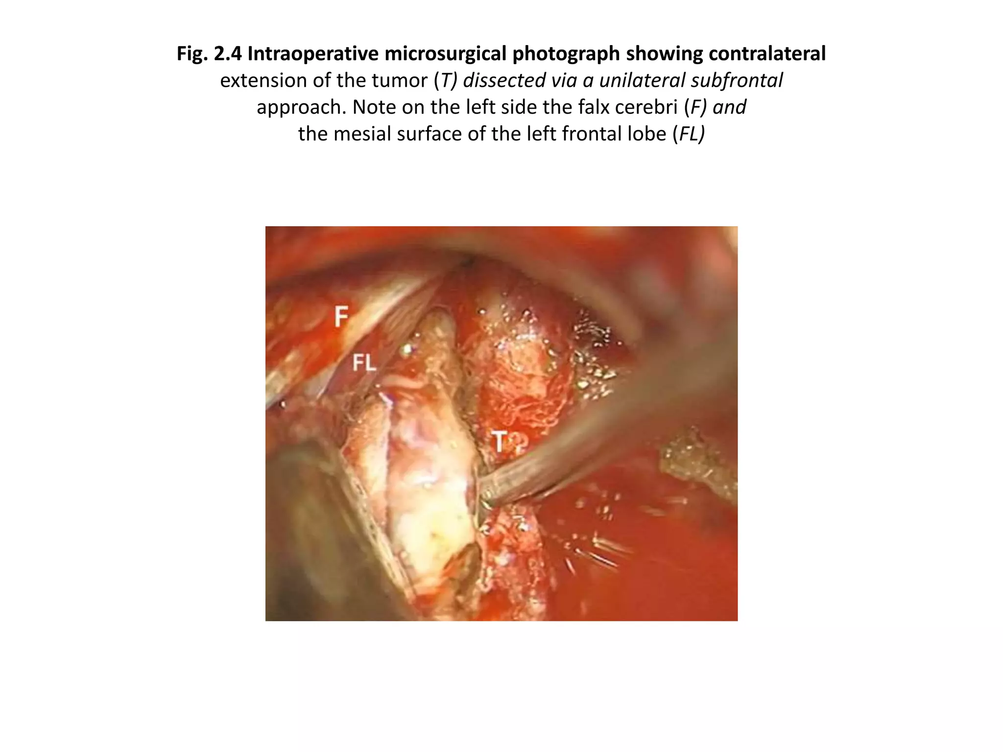 Fig. 2.4 Intraoperative microsurgical photograph showing contralateral
extension of the tumor (T) dissected via a unilateral subfrontal
approach. Note on the left side the falx cerebri (F) and
the mesial surface of the left frontal lobe (FL)
 