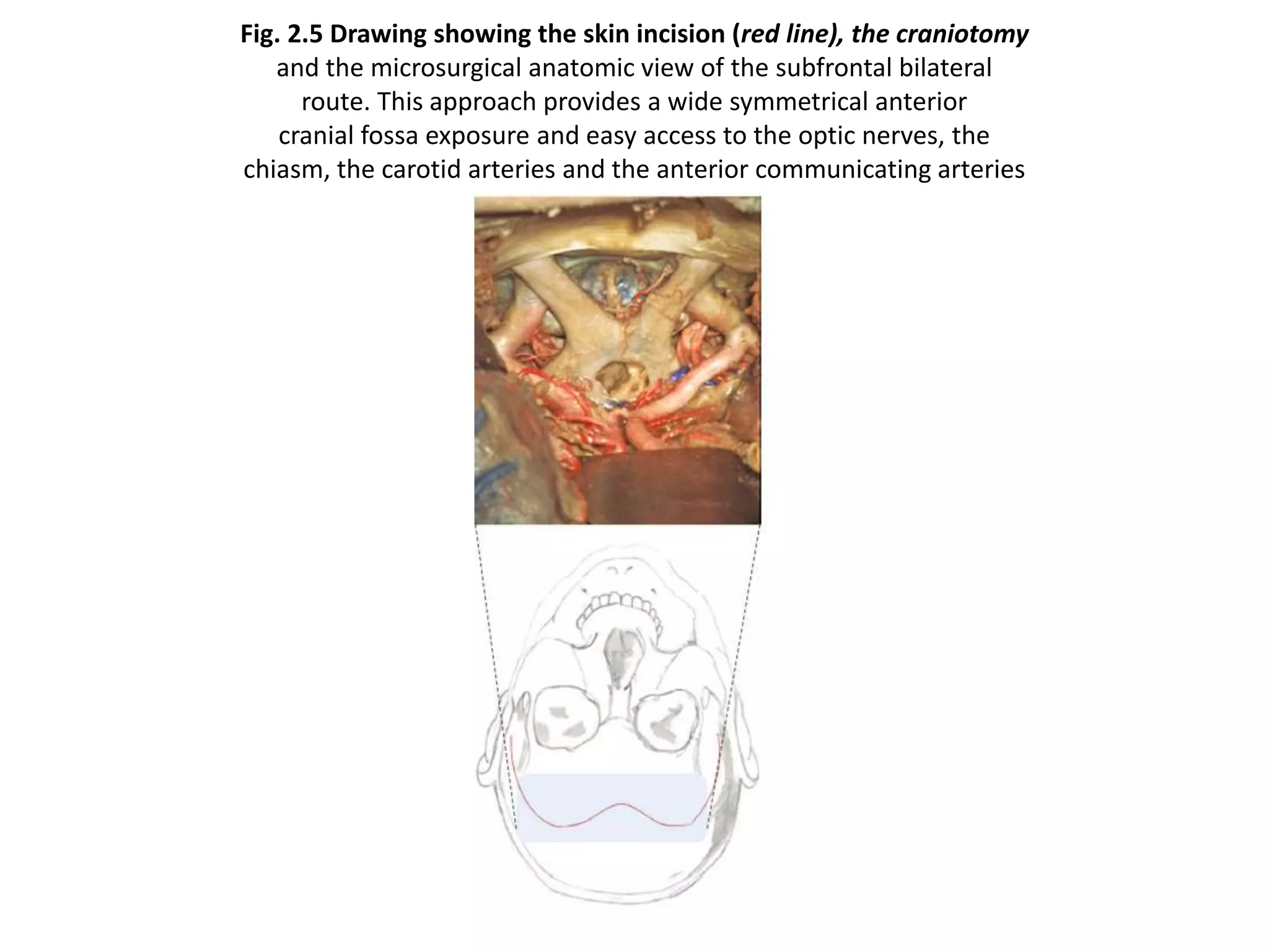 Fig. 2.5 Drawing showing the skin incision (red line), the craniotomy
and the microsurgical anatomic view of the subfrontal bilateral
route. This approach provides a wide symmetrical anterior
cranial fossa exposure and easy access to the optic nerves, the
chiasm, the carotid arteries and the anterior communicating arteries
complex
 