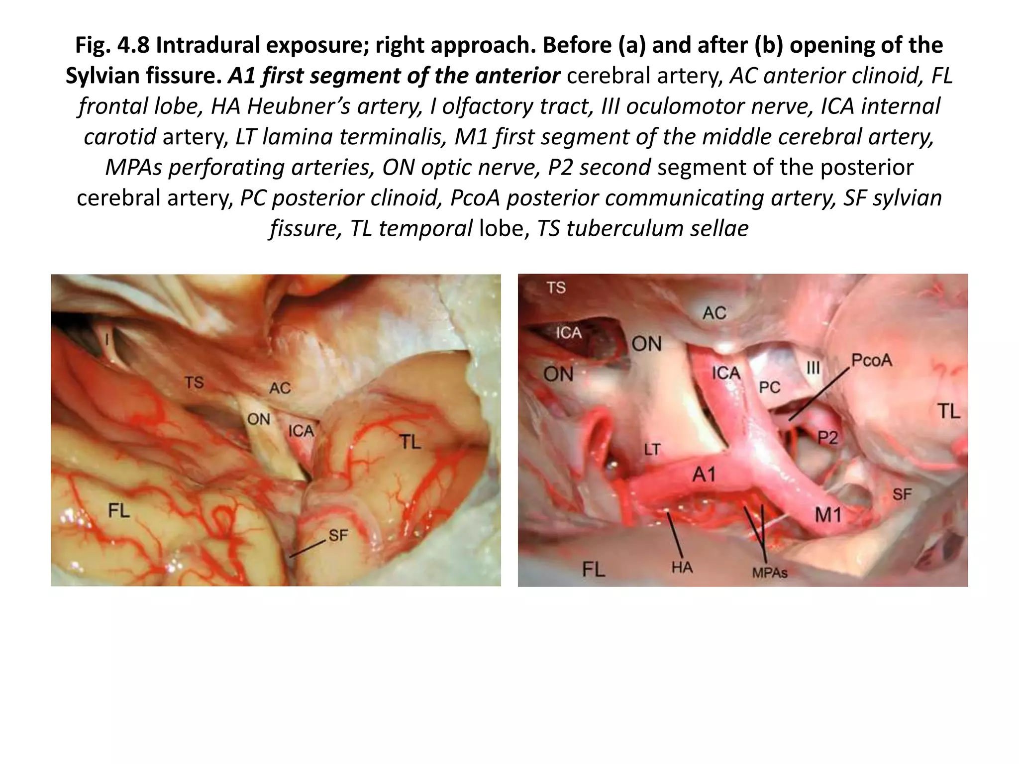 Fig. 4.8 Intradural exposure; right approach. Before (a) and after (b) opening of the
Sylvian fissure. A1 first segment of the anterior cerebral artery, AC anterior clinoid, FL
frontal lobe, HA Heubner’s artery, I olfactory tract, III oculomotor nerve, ICA internal
carotid artery, LT lamina terminalis, M1 first segment of the middle cerebral artery,
MPAs perforating arteries, ON optic nerve, P2 second segment of the posterior
cerebral artery, PC posterior clinoid, PcoA posterior communicating artery, SF sylvian
fissure, TL temporal lobe, TS tuberculum sellae
 