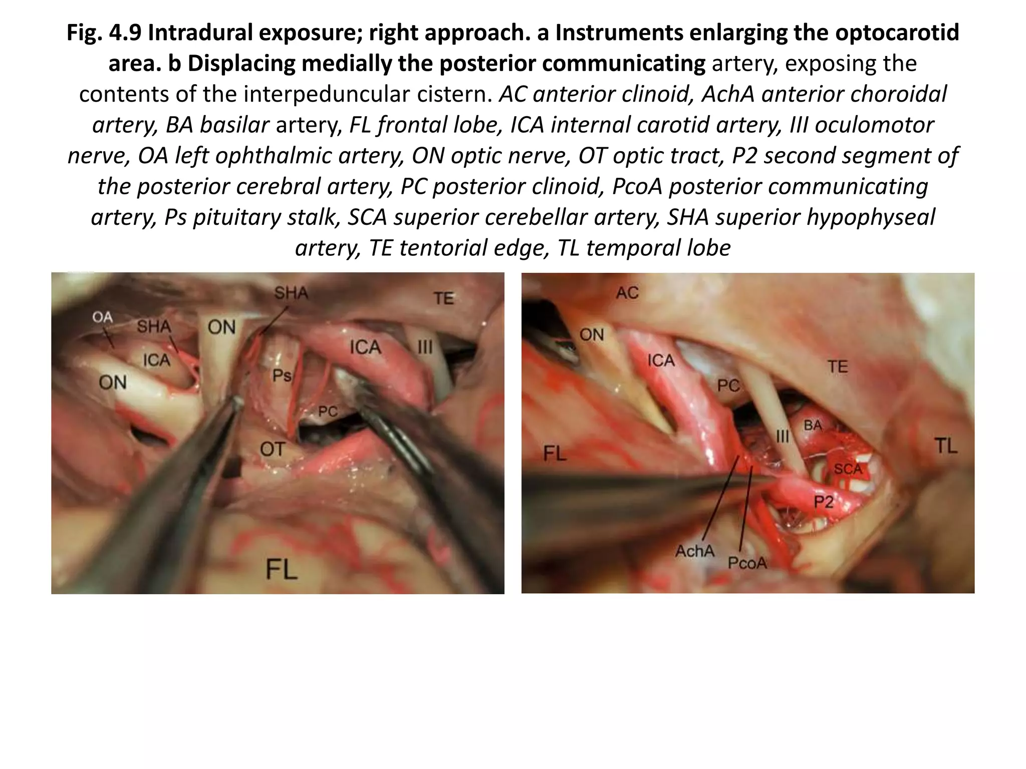 Fig. 4.9 Intradural exposure; right approach. a Instruments enlarging the optocarotid
area. b Displacing medially the posterior communicating artery, exposing the
contents of the interpeduncular cistern. AC anterior clinoid, AchA anterior choroidal
artery, BA basilar artery, FL frontal lobe, ICA internal carotid artery, III oculomotor
nerve, OA left ophthalmic artery, ON optic nerve, OT optic tract, P2 second segment of
the posterior cerebral artery, PC posterior clinoid, PcoA posterior communicating
artery, Ps pituitary stalk, SCA superior cerebellar artery, SHA superior hypophyseal
artery, TE tentorial edge, TL temporal lobe
 