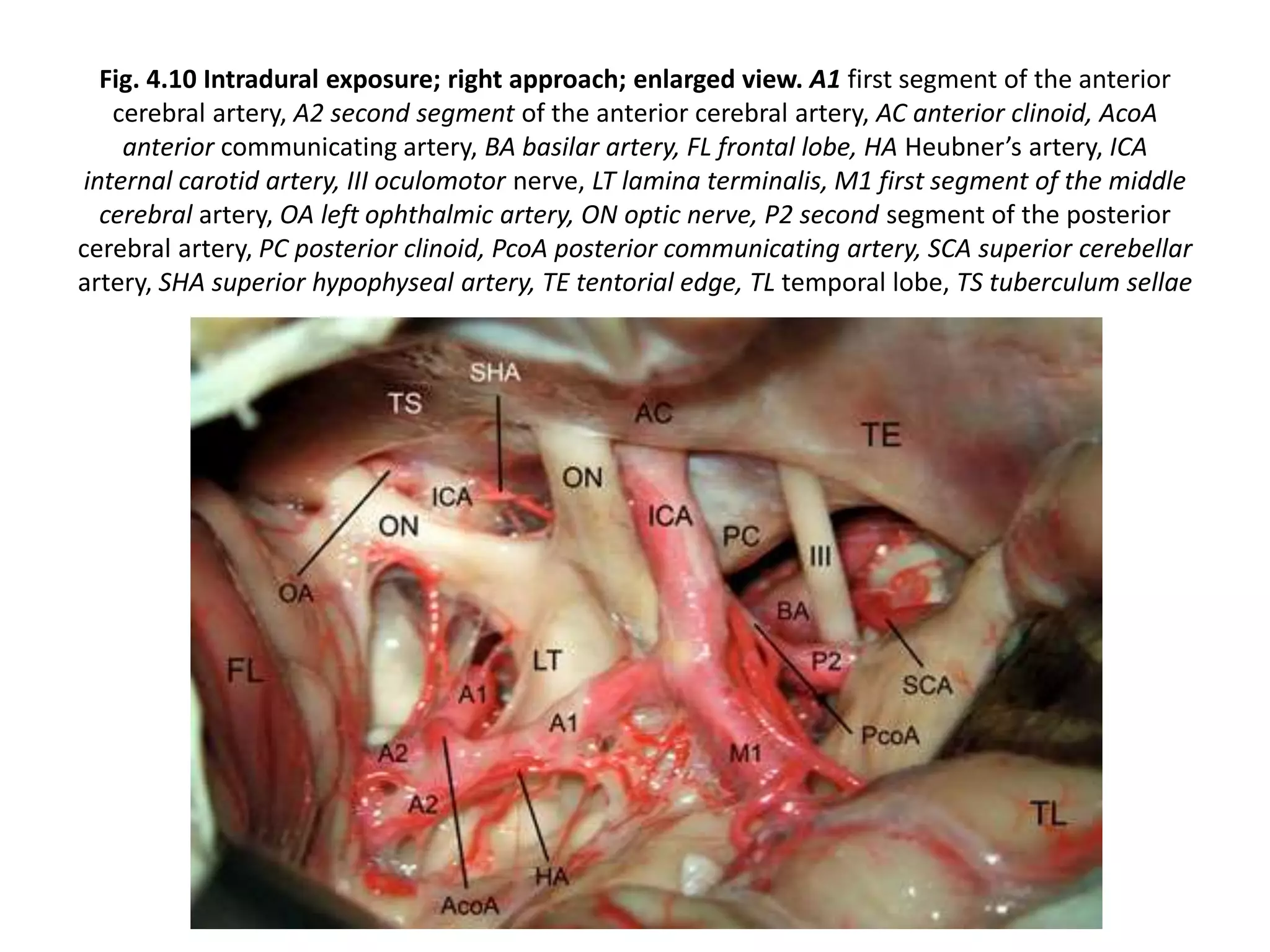 Fig. 4.10 Intradural exposure; right approach; enlarged view. A1 first segment of the anterior
cerebral artery, A2 second segment of the anterior cerebral artery, AC anterior clinoid, AcoA
anterior communicating artery, BA basilar artery, FL frontal lobe, HA Heubner’s artery, ICA
internal carotid artery, III oculomotor nerve, LT lamina terminalis, M1 first segment of the middle
cerebral artery, OA left ophthalmic artery, ON optic nerve, P2 second segment of the posterior
cerebral artery, PC posterior clinoid, PcoA posterior communicating artery, SCA superior cerebellar
artery, SHA superior hypophyseal artery, TE tentorial edge, TL temporal lobe, TS tuberculum sellae
 