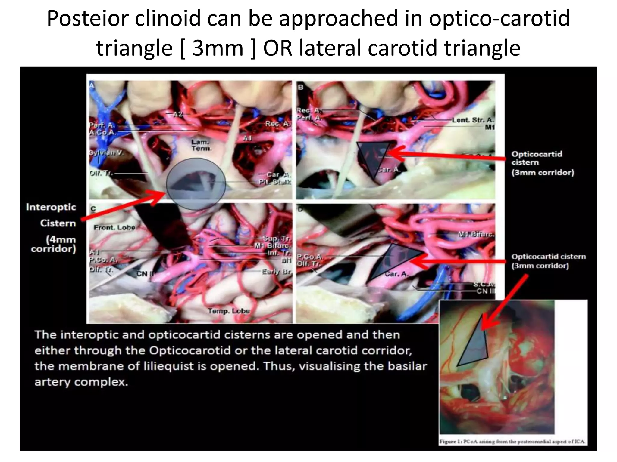 Posteior clinoid can be approached in optico-carotid
triangle [ 3mm ] OR lateral carotid triangle
 