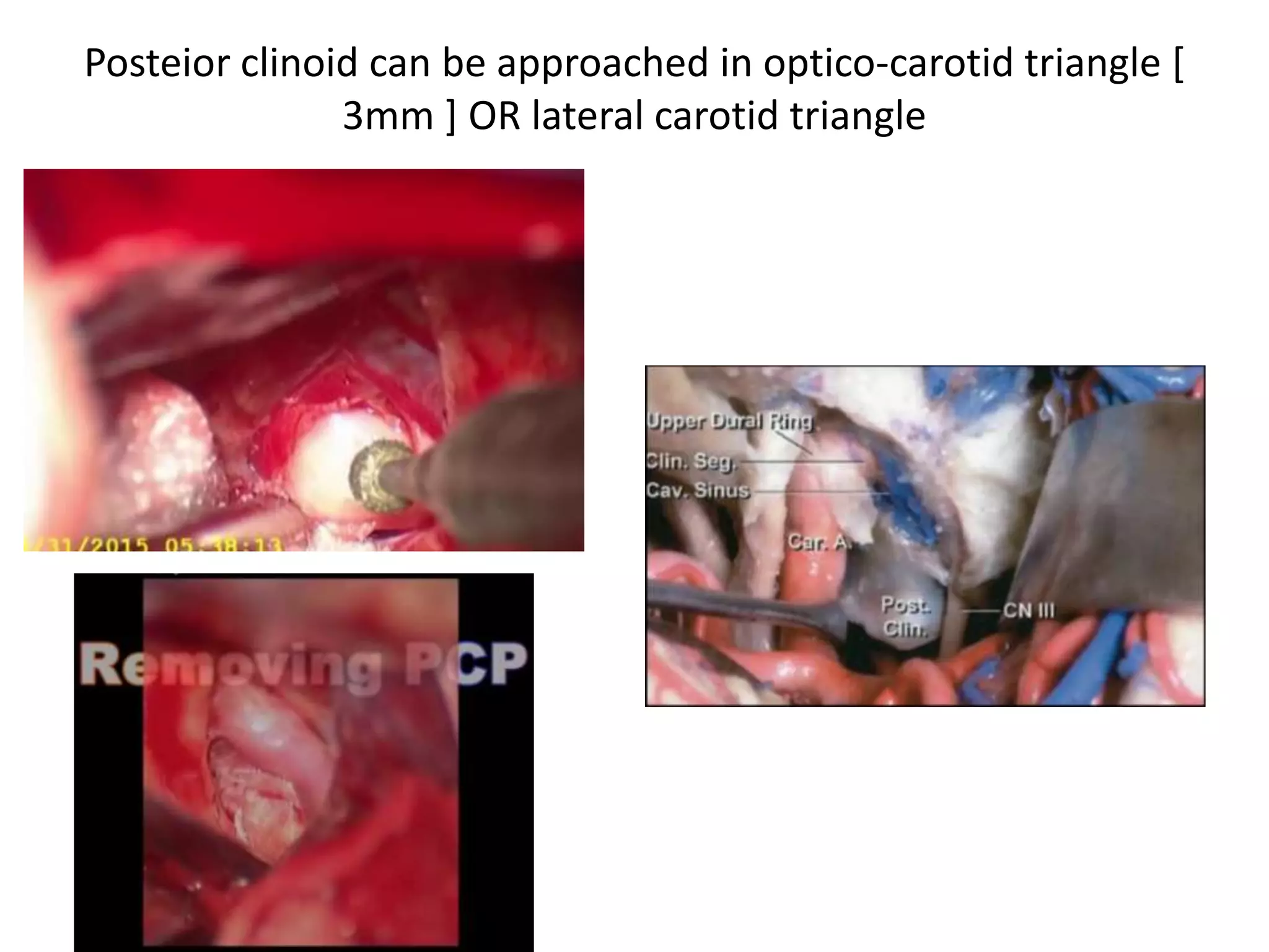 Posteior clinoid can be approached in optico-carotid triangle [
3mm ] OR lateral carotid triangle
 