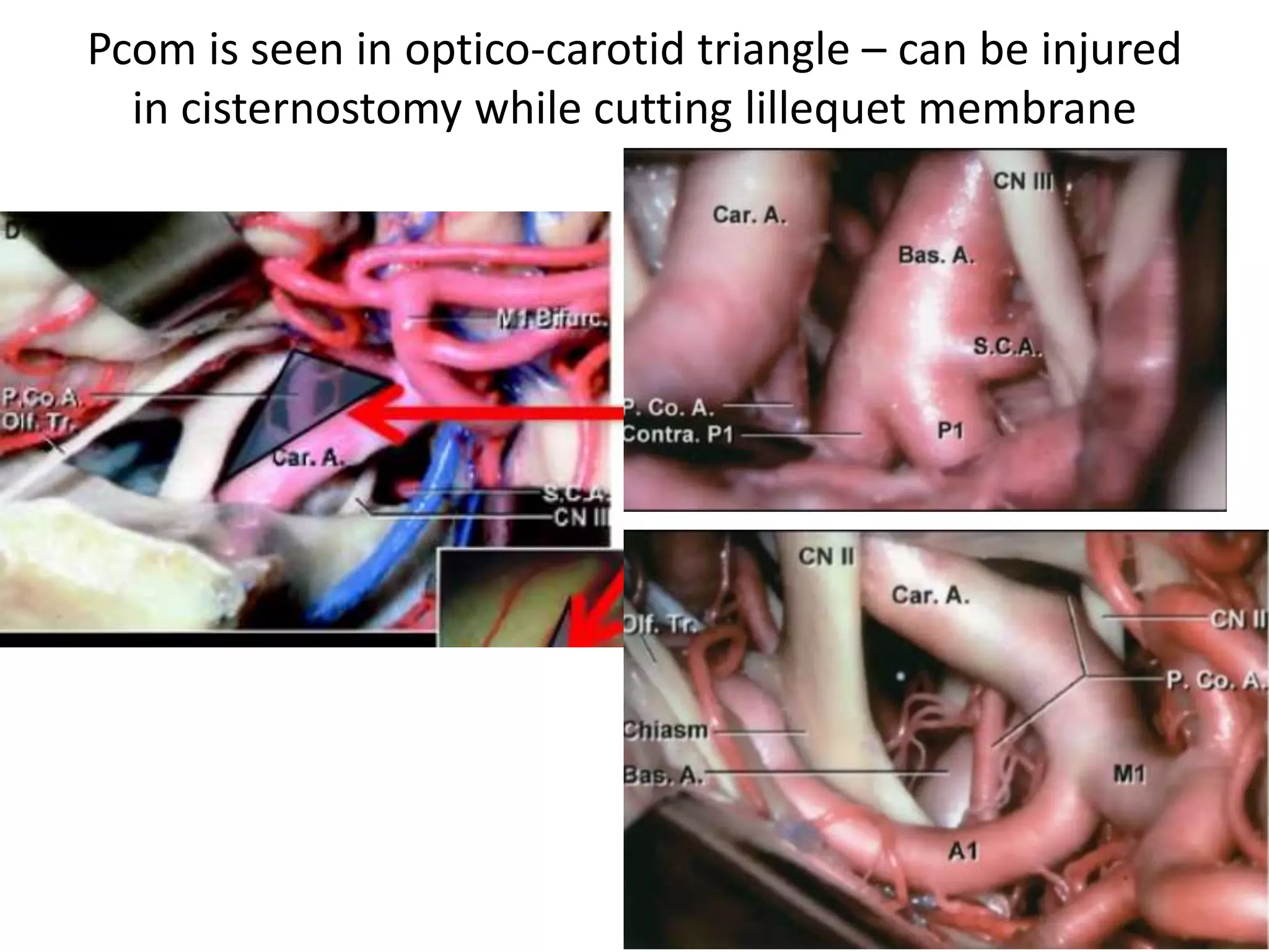 Pcom is seen in optico-carotid triangle – can be injured
in cisternostomy while cutting lillequet membrane
 