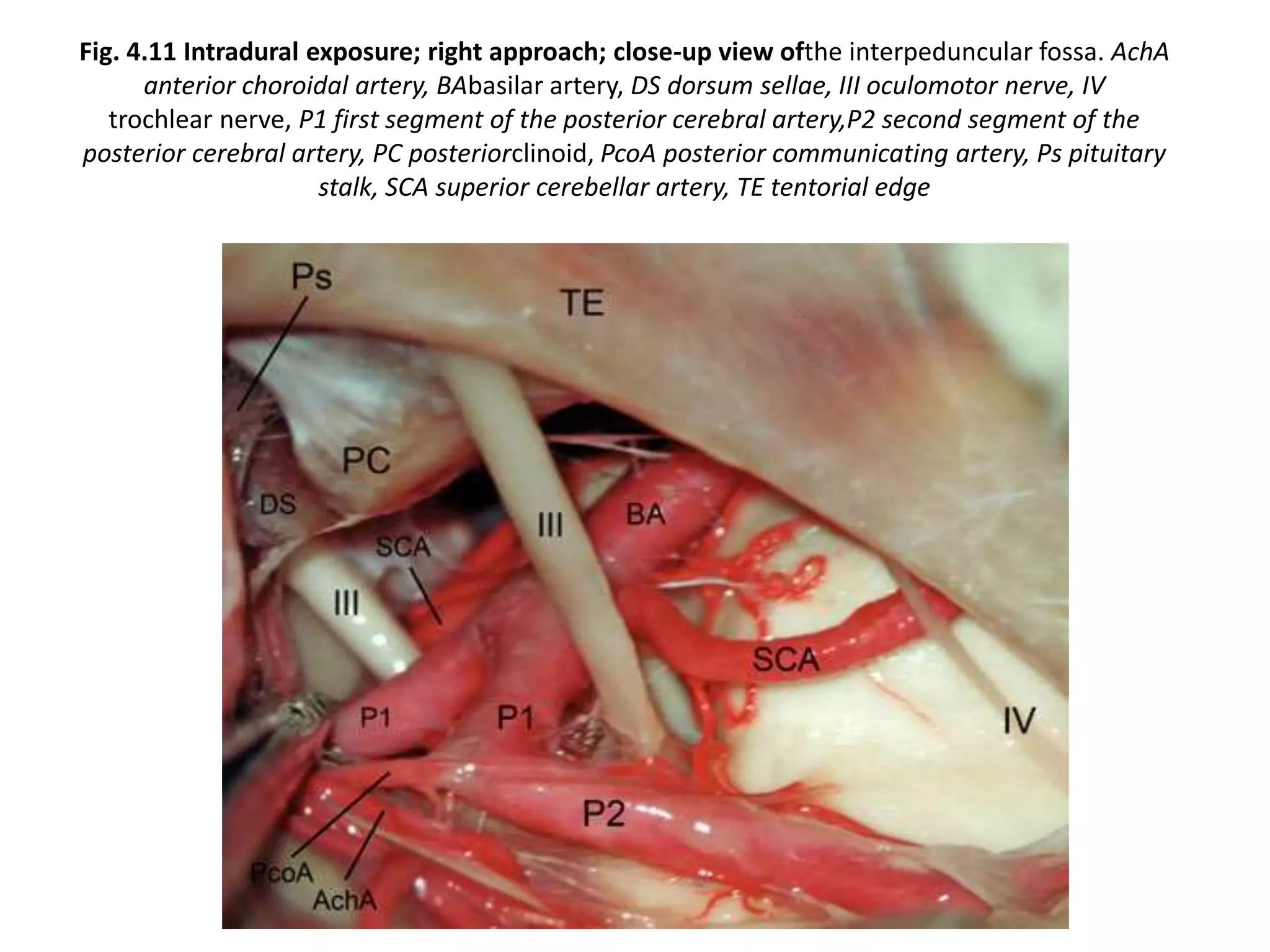Fig. 4.11 Intradural exposure; right approach; close-up view ofthe interpeduncular fossa. AchA
anterior choroidal artery, BAbasilar artery, DS dorsum sellae, III oculomotor nerve, IV
trochlear nerve, P1 first segment of the posterior cerebral artery,P2 second segment of the
posterior cerebral artery, PC posteriorclinoid, PcoA posterior communicating artery, Ps pituitary
stalk, SCA superior cerebellar artery, TE tentorial edge
 