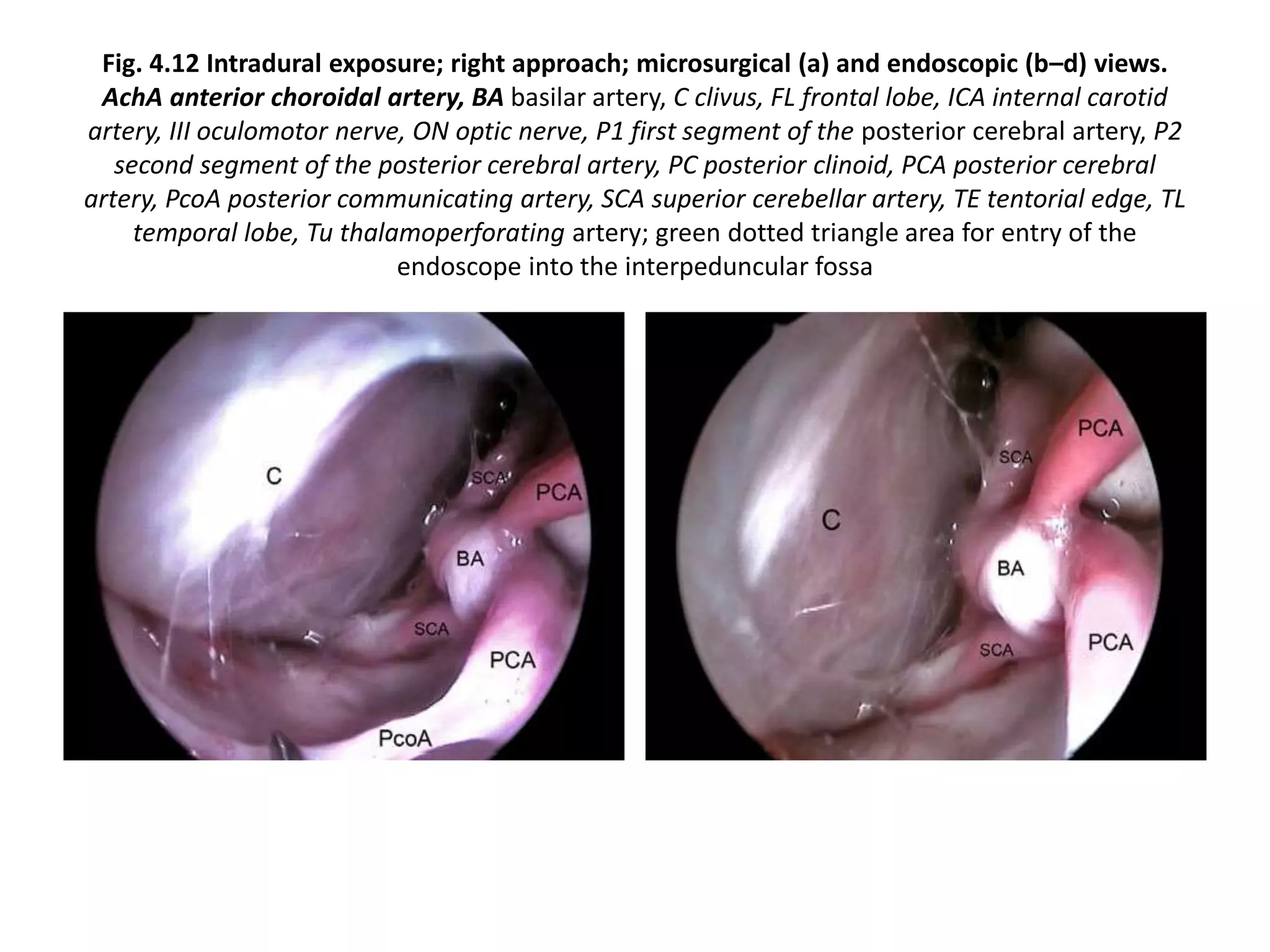 Fig. 4.12 Intradural exposure; right approach; microsurgical (a) and endoscopic (b–d) views.
AchA anterior choroidal artery, BA basilar artery, C clivus, FL frontal lobe, ICA internal carotid
artery, III oculomotor nerve, ON optic nerve, P1 first segment of the posterior cerebral artery, P2
second segment of the posterior cerebral artery, PC posterior clinoid, PCA posterior cerebral
artery, PcoA posterior communicating artery, SCA superior cerebellar artery, TE tentorial edge, TL
temporal lobe, Tu thalamoperforating artery; green dotted triangle area for entry of the
endoscope into the interpeduncular fossa
 