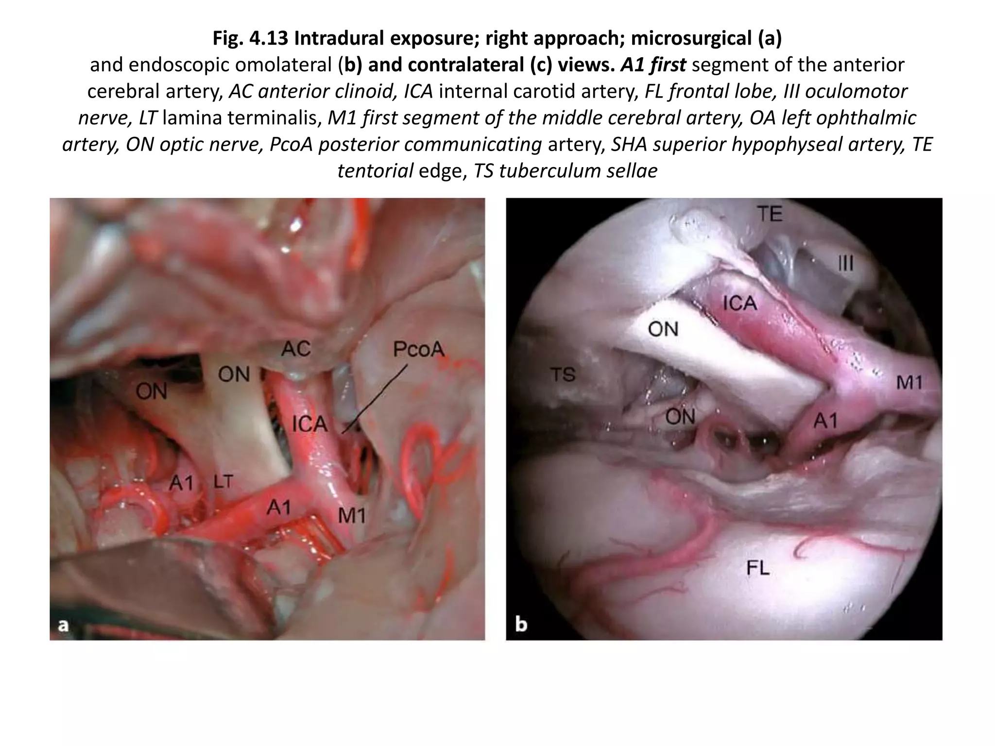 Fig. 4.13 Intradural exposure; right approach; microsurgical (a)
and endoscopic omolateral (b) and contralateral (c) views. A1 first segment of the anterior
cerebral artery, AC anterior clinoid, ICA internal carotid artery, FL frontal lobe, III oculomotor
nerve, LT lamina terminalis, M1 first segment of the middle cerebral artery, OA left ophthalmic
artery, ON optic nerve, PcoA posterior communicating artery, SHA superior hypophyseal artery, TE
tentorial edge, TS tuberculum sellae
 