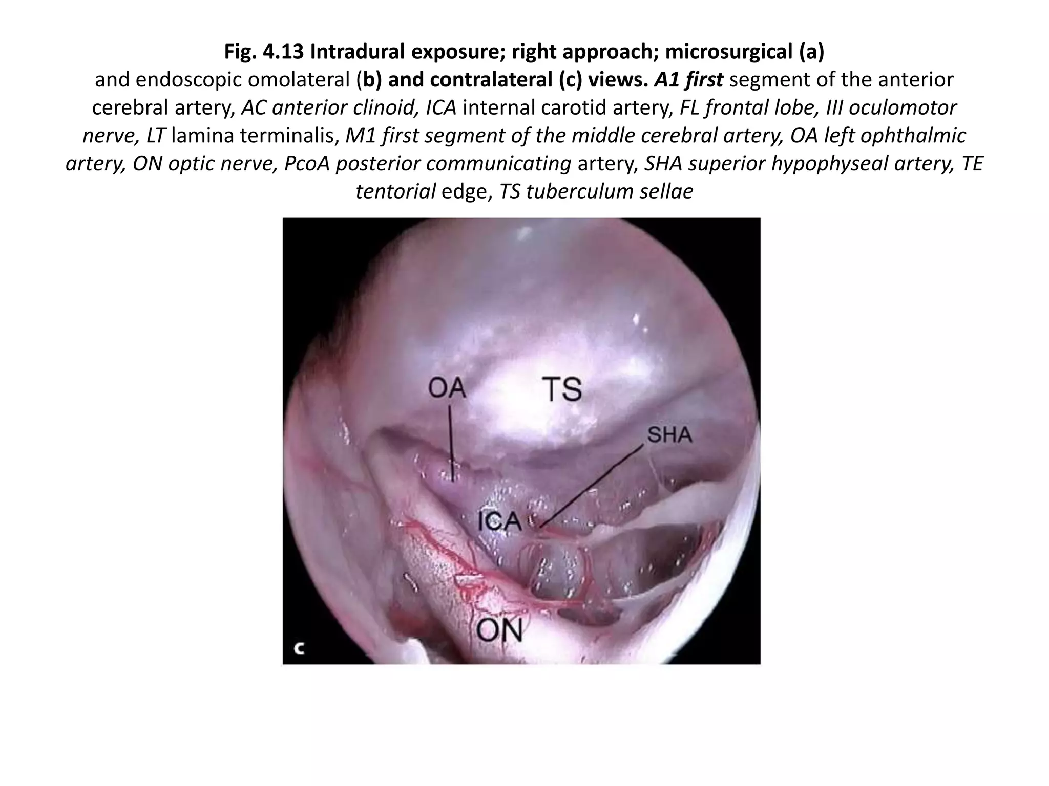 Fig. 4.13 Intradural exposure; right approach; microsurgical (a)
and endoscopic omolateral (b) and contralateral (c) views. A1 first segment of the anterior
cerebral artery, AC anterior clinoid, ICA internal carotid artery, FL frontal lobe, III oculomotor
nerve, LT lamina terminalis, M1 first segment of the middle cerebral artery, OA left ophthalmic
artery, ON optic nerve, PcoA posterior communicating artery, SHA superior hypophyseal artery, TE
tentorial edge, TS tuberculum sellae
 