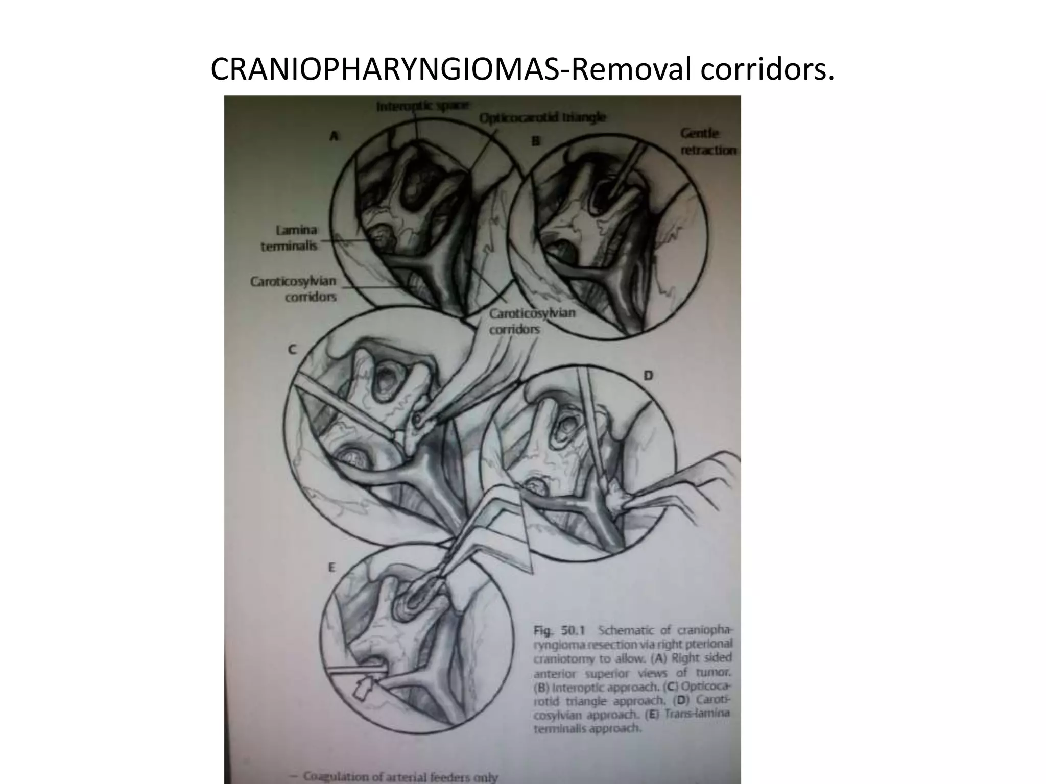 CRANIOPHARYNGIOMAS-Removal corridors.
 