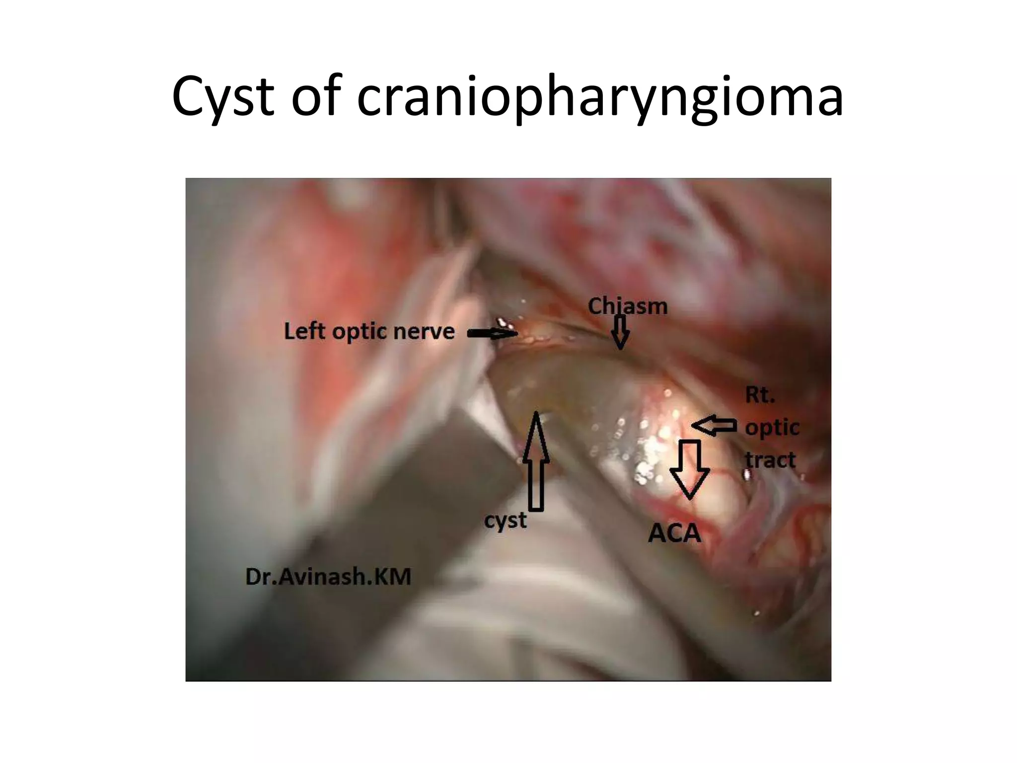 Cyst of craniopharyngioma
 