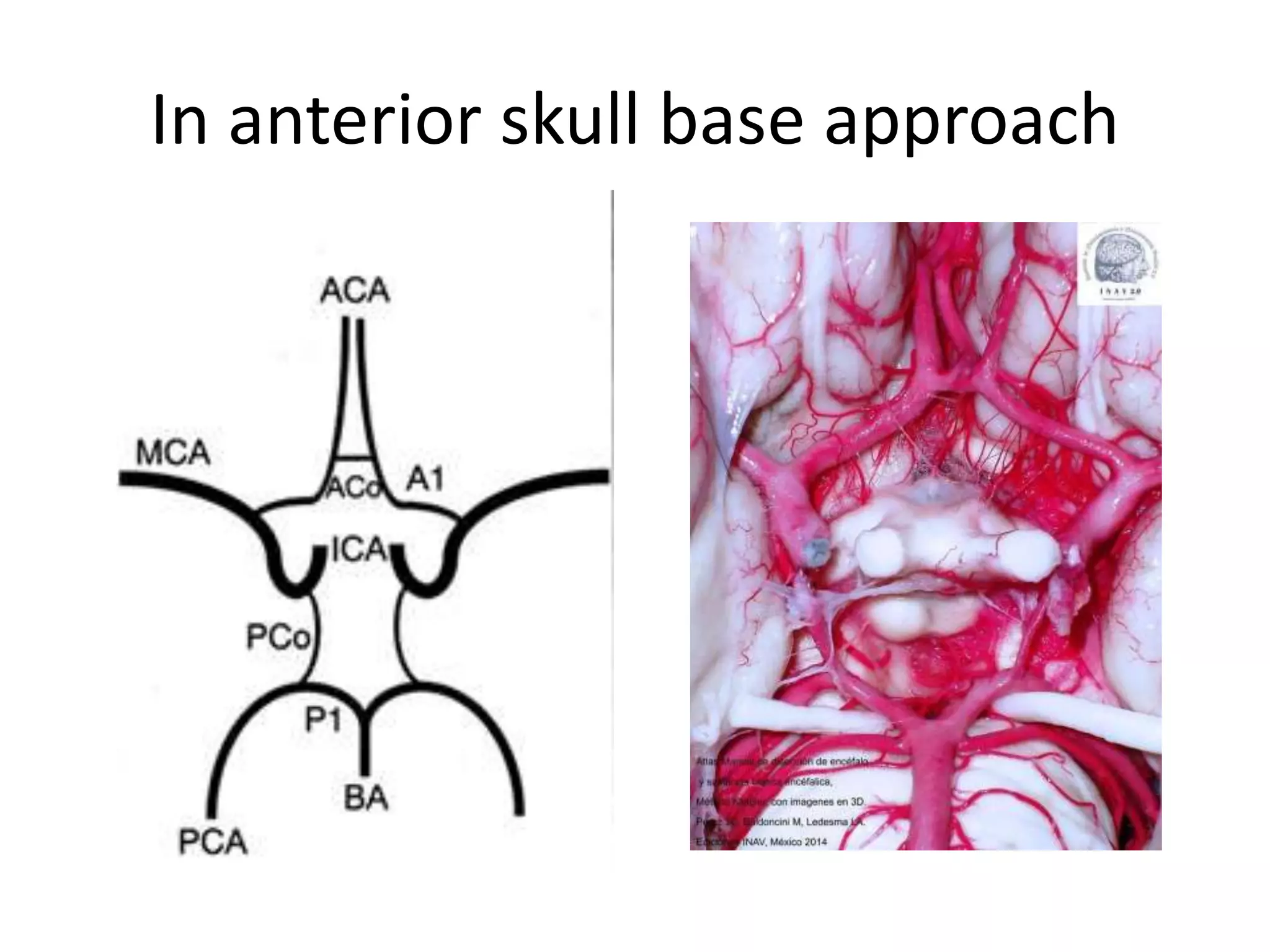 In anterior skull base approach
 