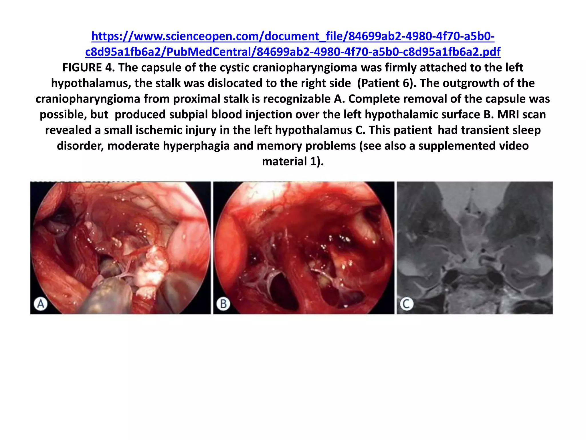 https://www.scienceopen.com/document_file/84699ab2-4980-4f70-a5b0-
c8d95a1fb6a2/PubMedCentral/84699ab2-4980-4f70-a5b0-c8d95a1fb6a2.pdf
FIGURE 4. The capsule of the cystic craniopharyngioma was firmly attached to the left
hypothalamus, the stalk was dislocated to the right side (Patient 6). The outgrowth of the
craniopharyngioma from proximal stalk is recognizable A. Complete removal of the capsule was
possible, but produced subpial blood injection over the left hypothalamic surface B. MRI scan
revealed a small ischemic injury in the left hypothalamus C. This patient had transient sleep
disorder, moderate hyperphagia and memory problems (see also a supplemented video
material 1).
 