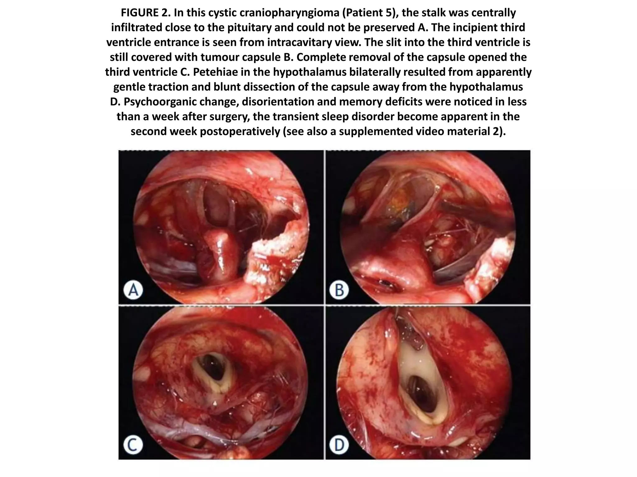 FIGURE 2. In this cystic craniopharyngioma (Patient 5), the stalk was centrally
infiltrated close to the pituitary and could not be preserved A. The incipient third
ventricle entrance is seen from intracavitary view. The slit into the third ventricle is
still covered with tumour capsule B. Complete removal of the capsule opened the
third ventricle C. Petehiae in the hypothalamus bilaterally resulted from apparently
gentle traction and blunt dissection of the capsule away from the hypothalamus
D. Psychoorganic change, disorientation and memory deficits were noticed in less
than a week after surgery, the transient sleep disorder become apparent in the
second week postoperatively (see also a supplemented video material 2).
 