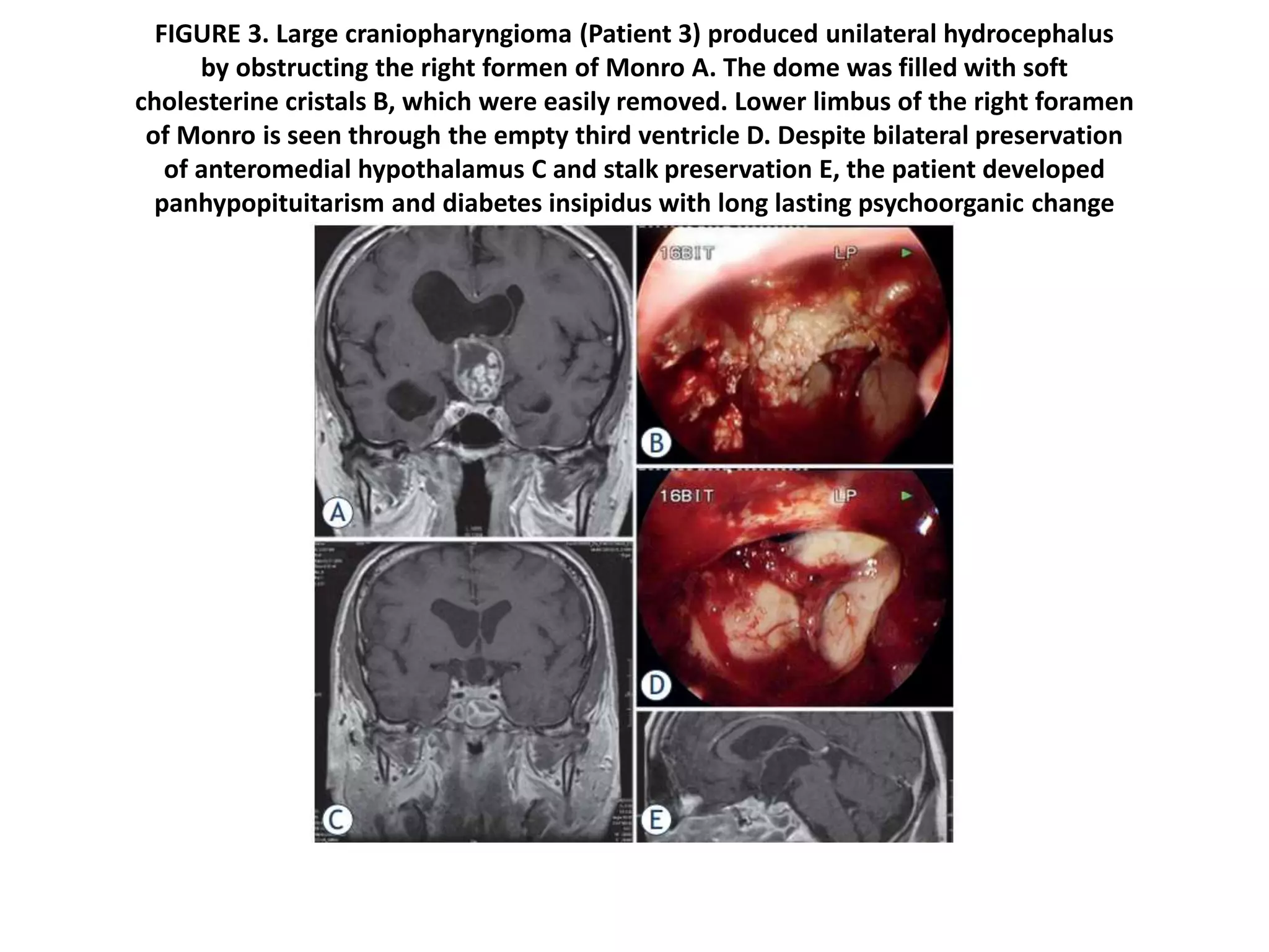 FIGURE 3. Large craniopharyngioma (Patient 3) produced unilateral hydrocephalus
by obstructing the right formen of Monro A. The dome was filled with soft
cholesterine cristals B, which were easily removed. Lower limbus of the right foramen
of Monro is seen through the empty third ventricle D. Despite bilateral preservation
of anteromedial hypothalamus C and stalk preservation E, the patient developed
panhypopituitarism and diabetes insipidus with long lasting psychoorganic change
 