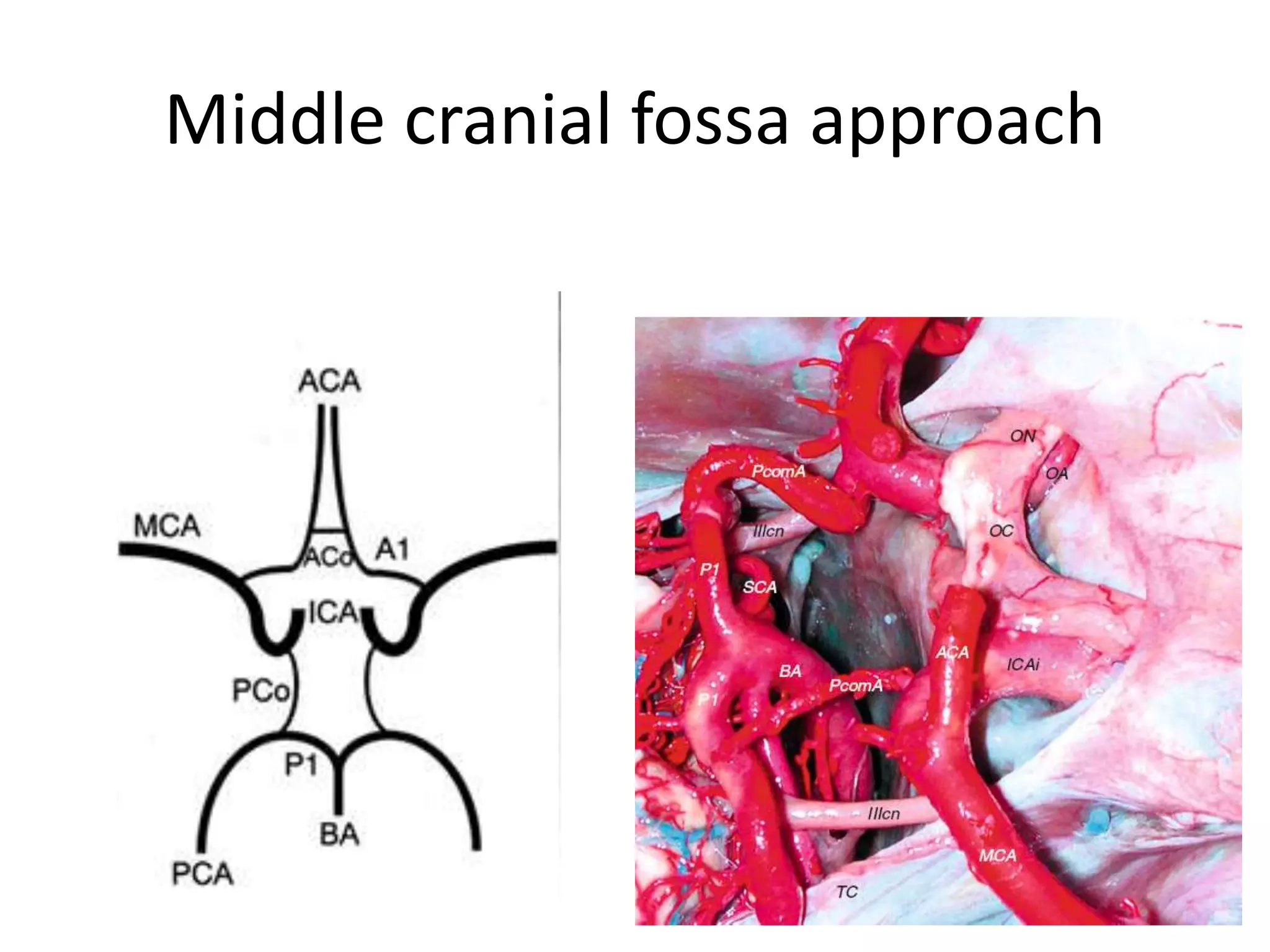 Middle cranial fossa approach
 