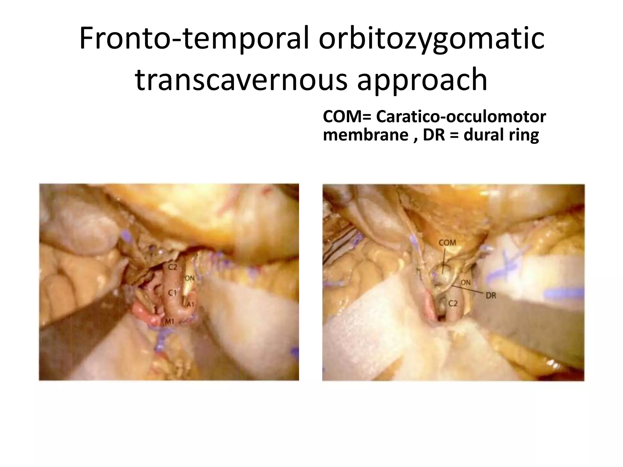 Fronto-temporal orbitozygomatic
transcavernous approach
COM= Caratico-occulomotor
membrane , DR = dural ring
 